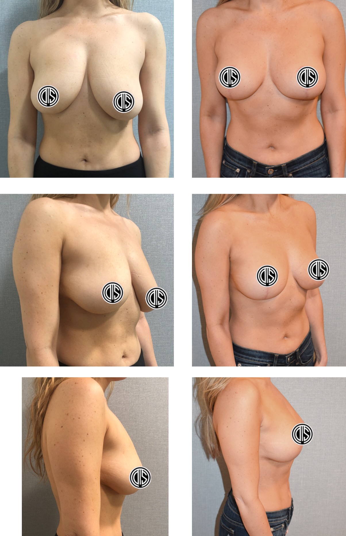 Before and after breast lift, case 5.