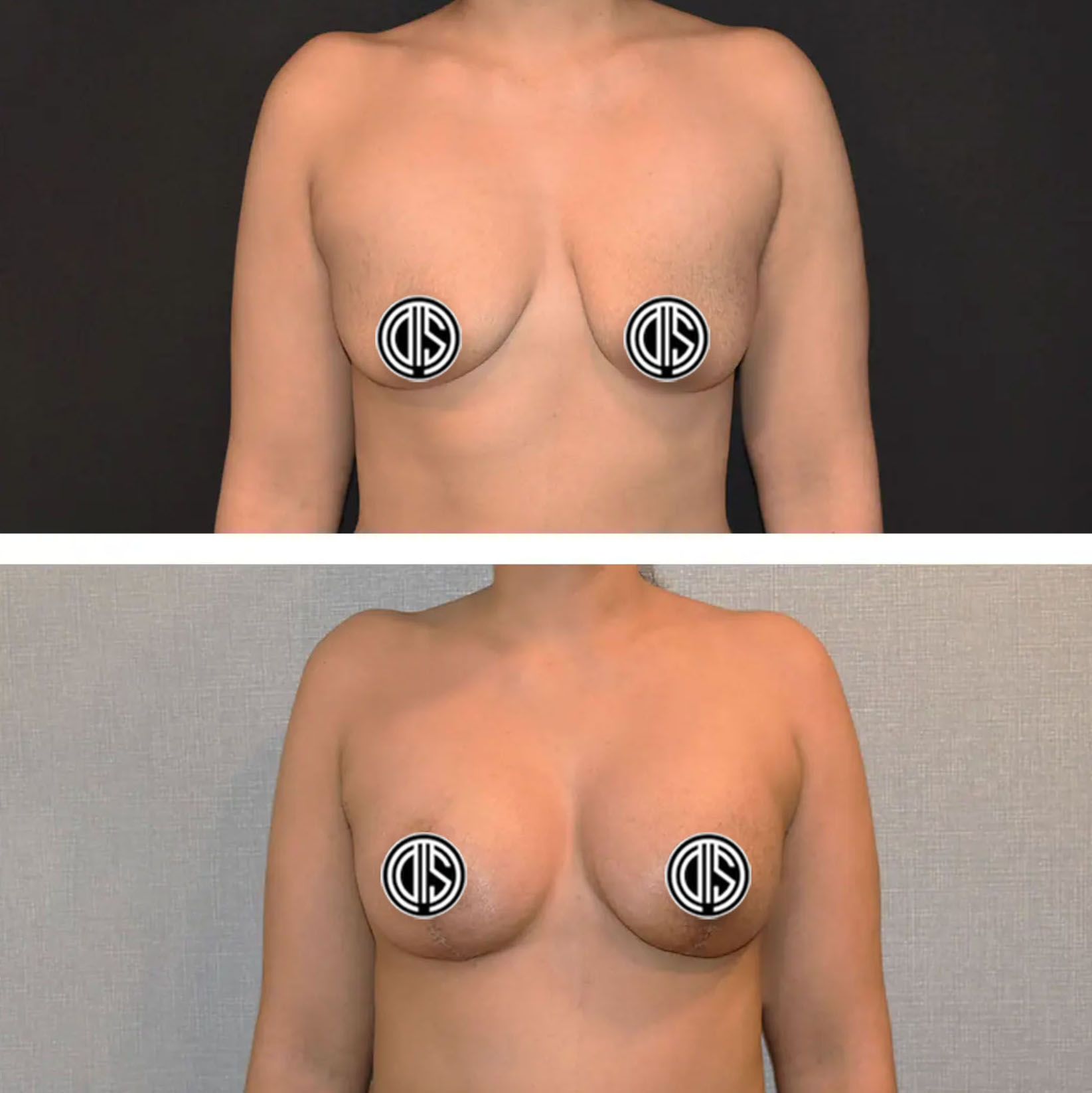 Before and after breast lift, case 6.
