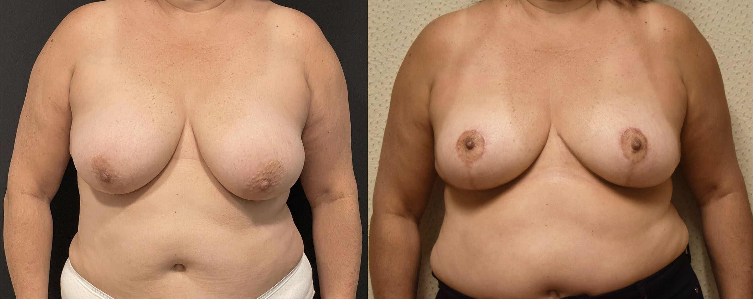 Before and after breast lift, case 7.