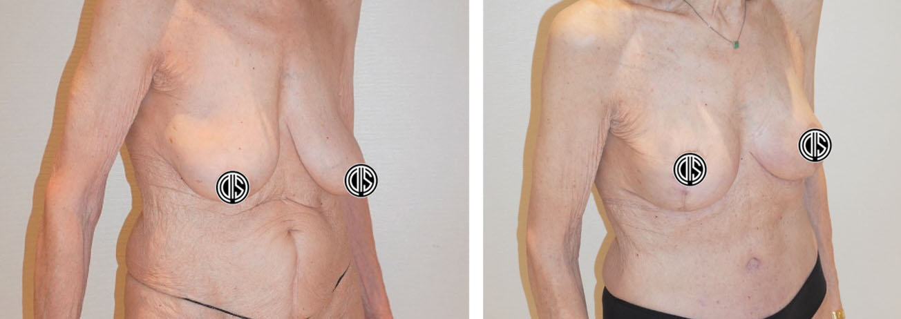 Before and after breast lift, case 8.