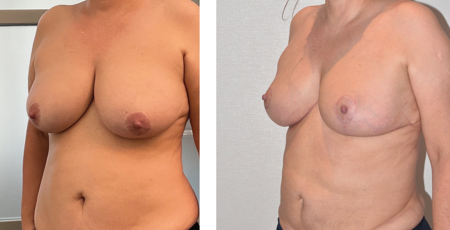 Before and after breast lift, case 9.