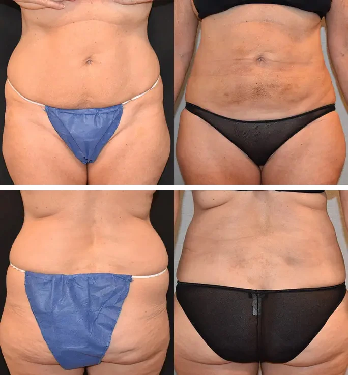 Before and after BodyTite, case 5.