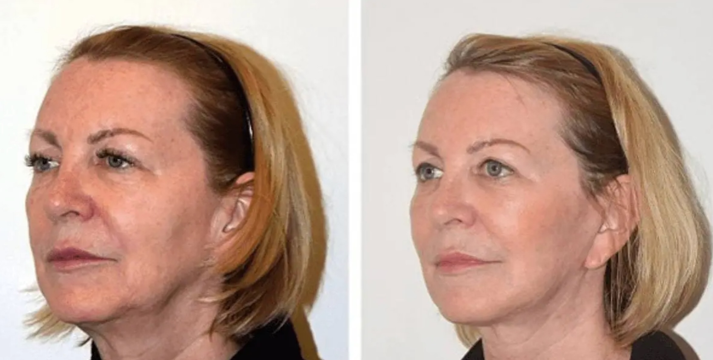 This woman wanted to address signs of facial aging. A facelift was performed.
