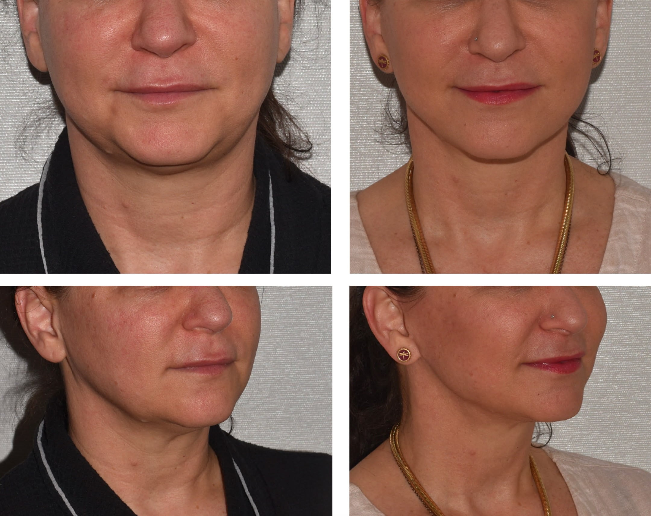 A woman in her early fifties was concerned about signs of facial and neck aging, including moderate skin laxity and volume loss. She underwent a facelift to address these concerns.