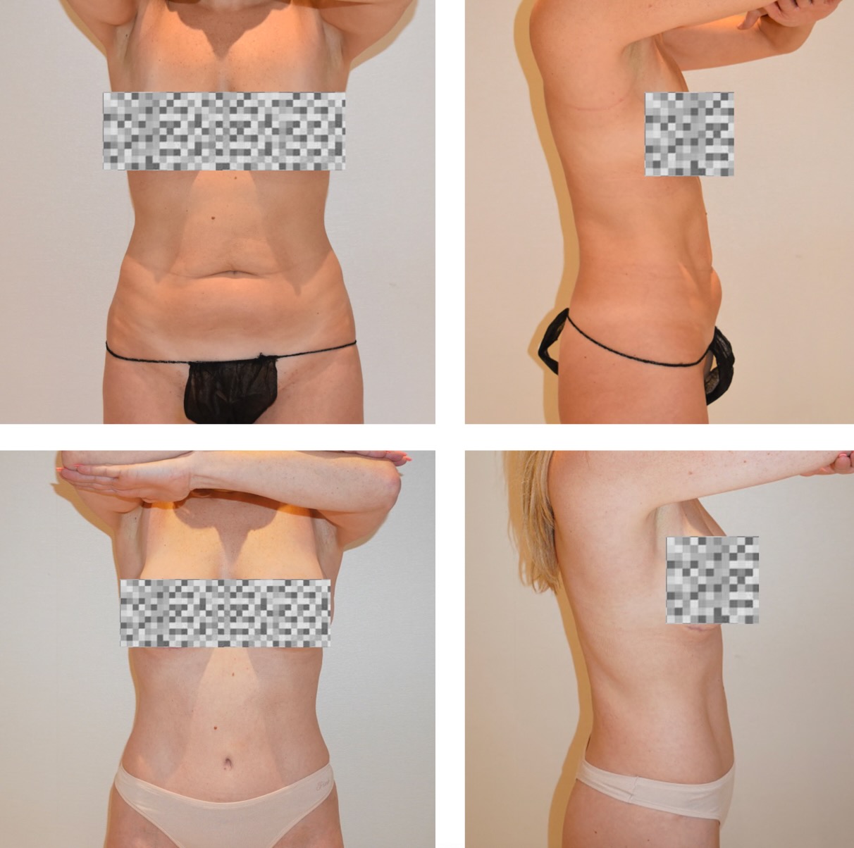 Before and after tummy tuck, case 1.