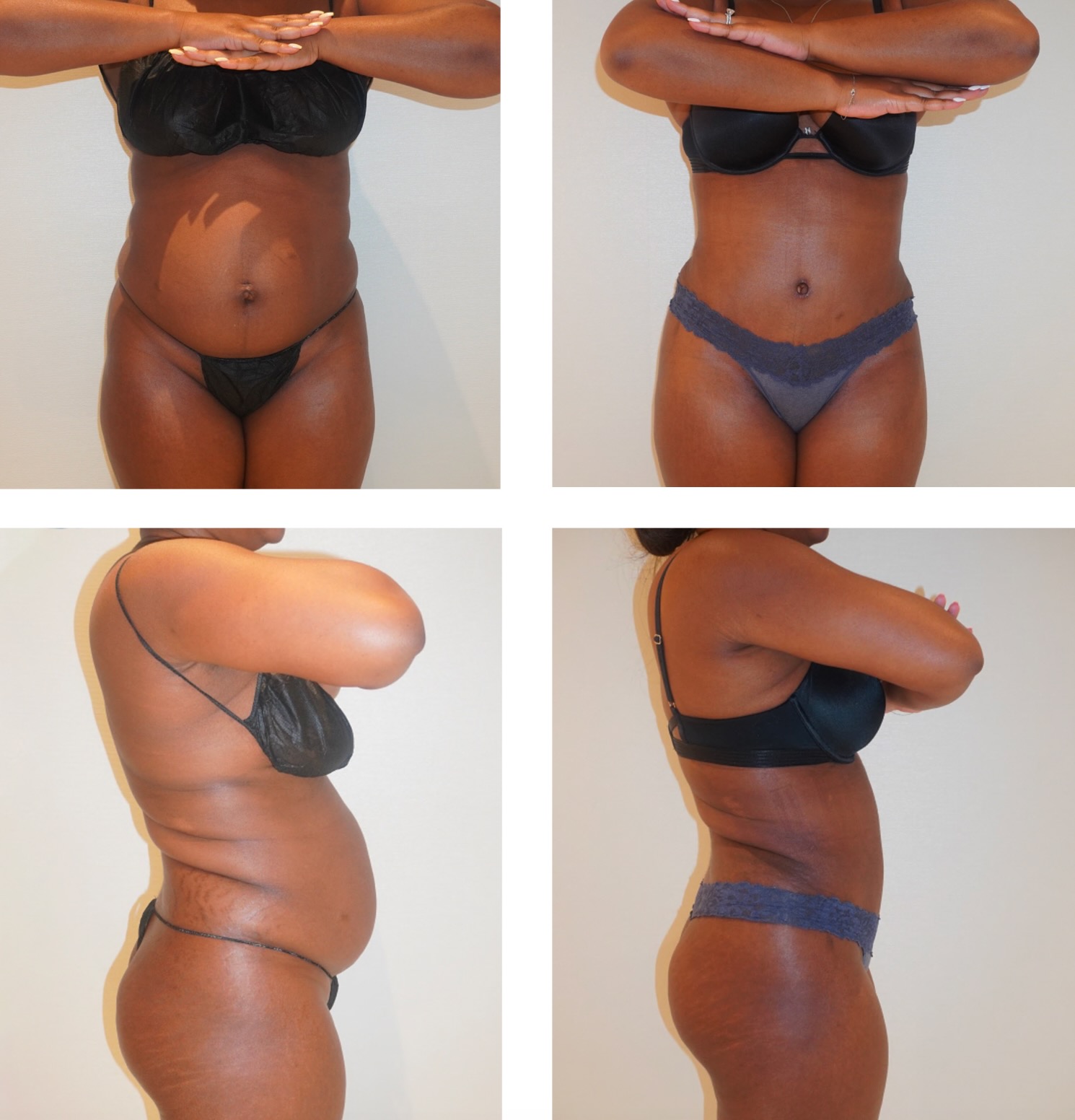 Before and after tummy tuck, case 5.