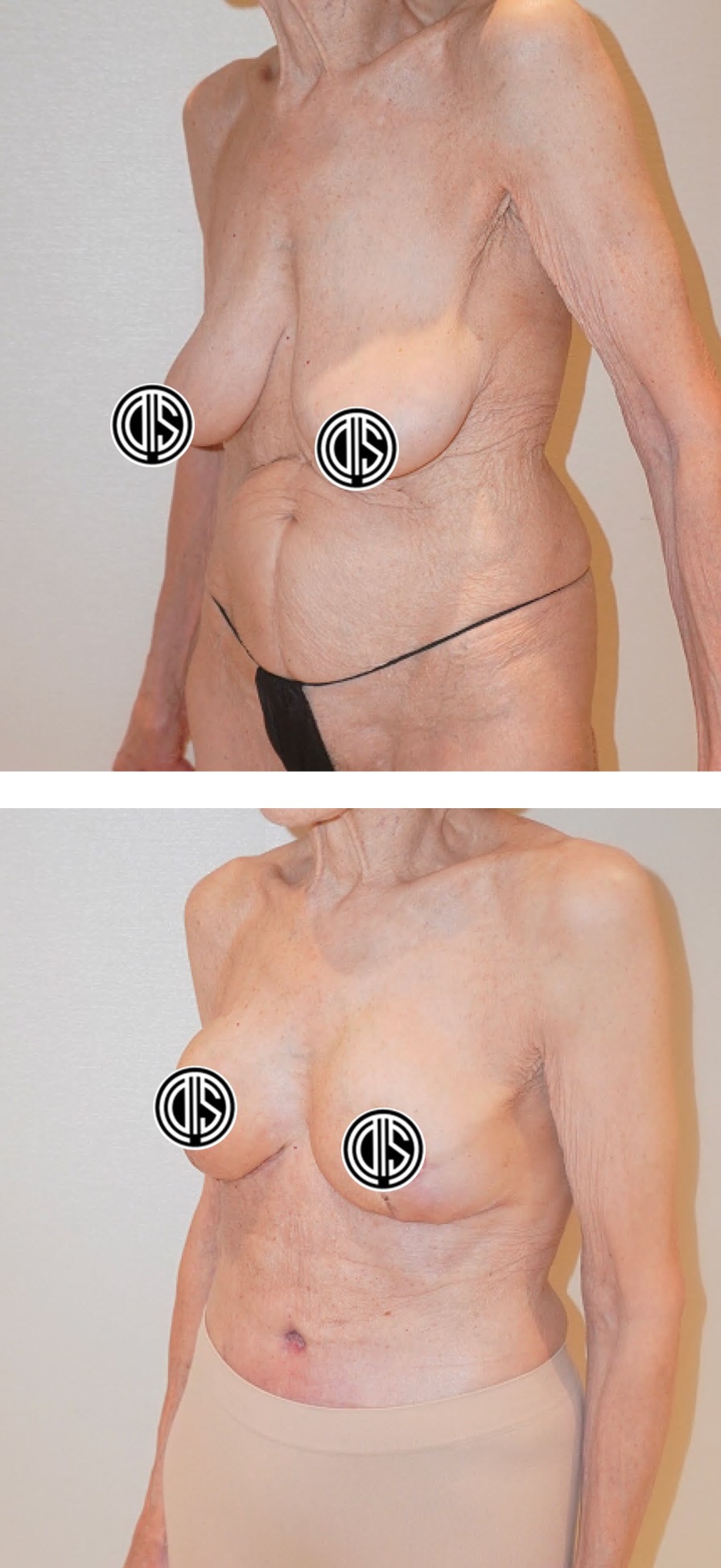 Before and after tummy tuck, case 8.