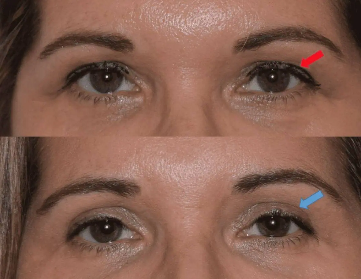 Before and after eyelid surgery, case 1.