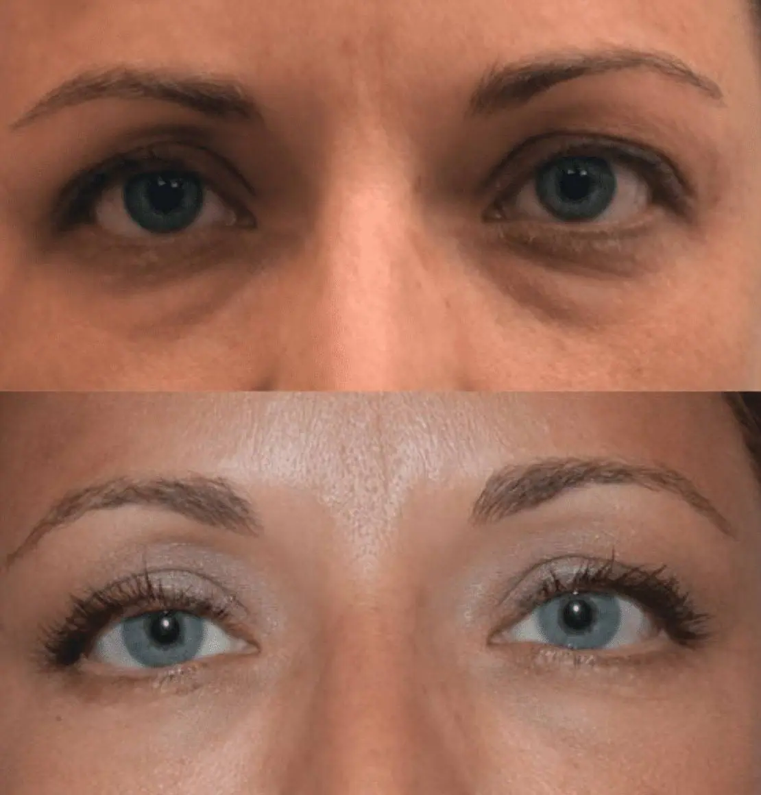 Before and after eyelid surgery, case 2.