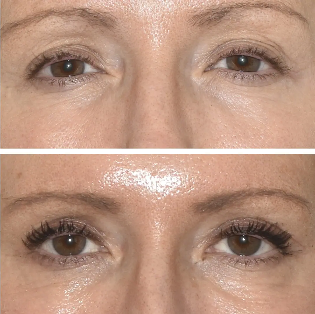 Before and after eyelid surgery, case 3.