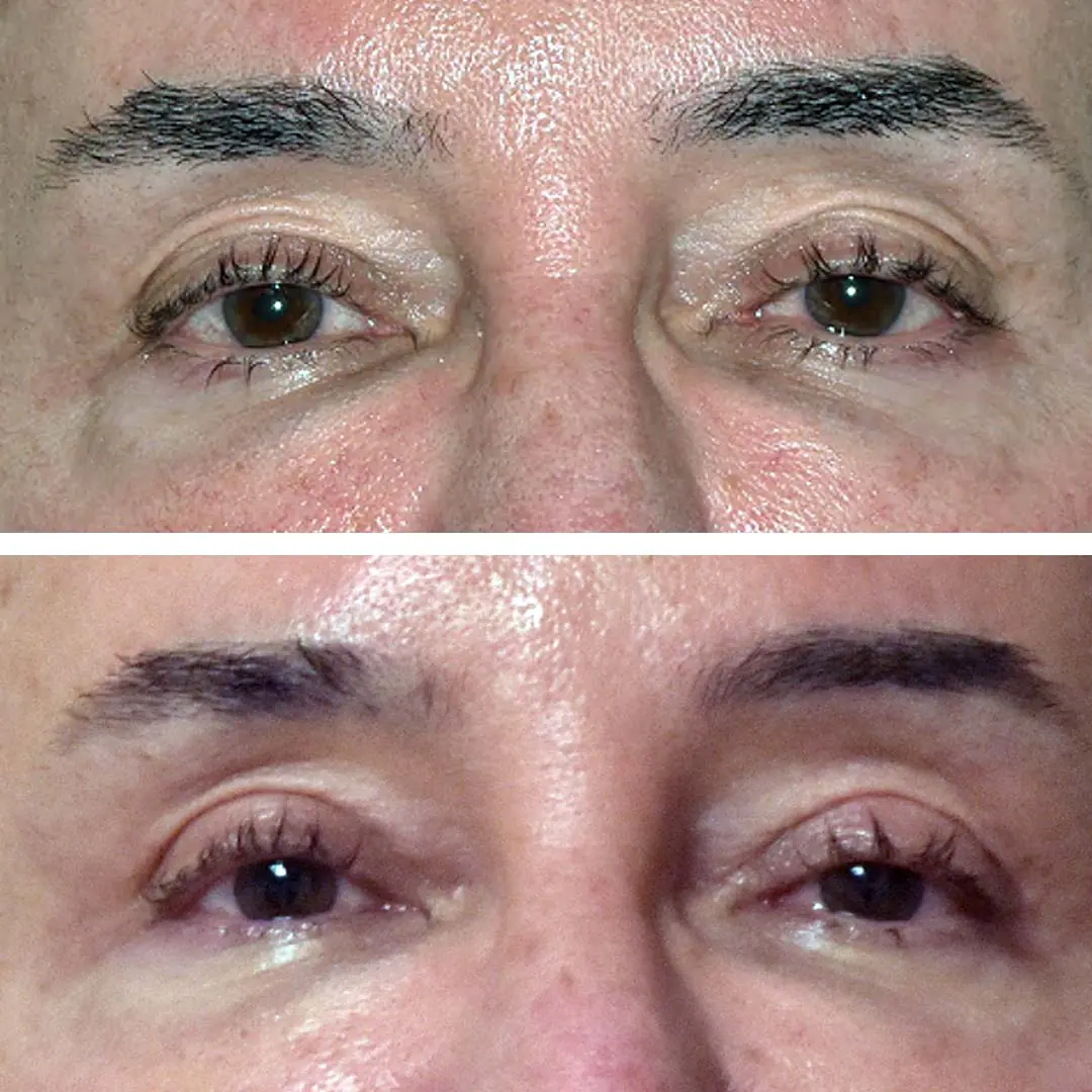 Before and after eyelid surgery, case 4.