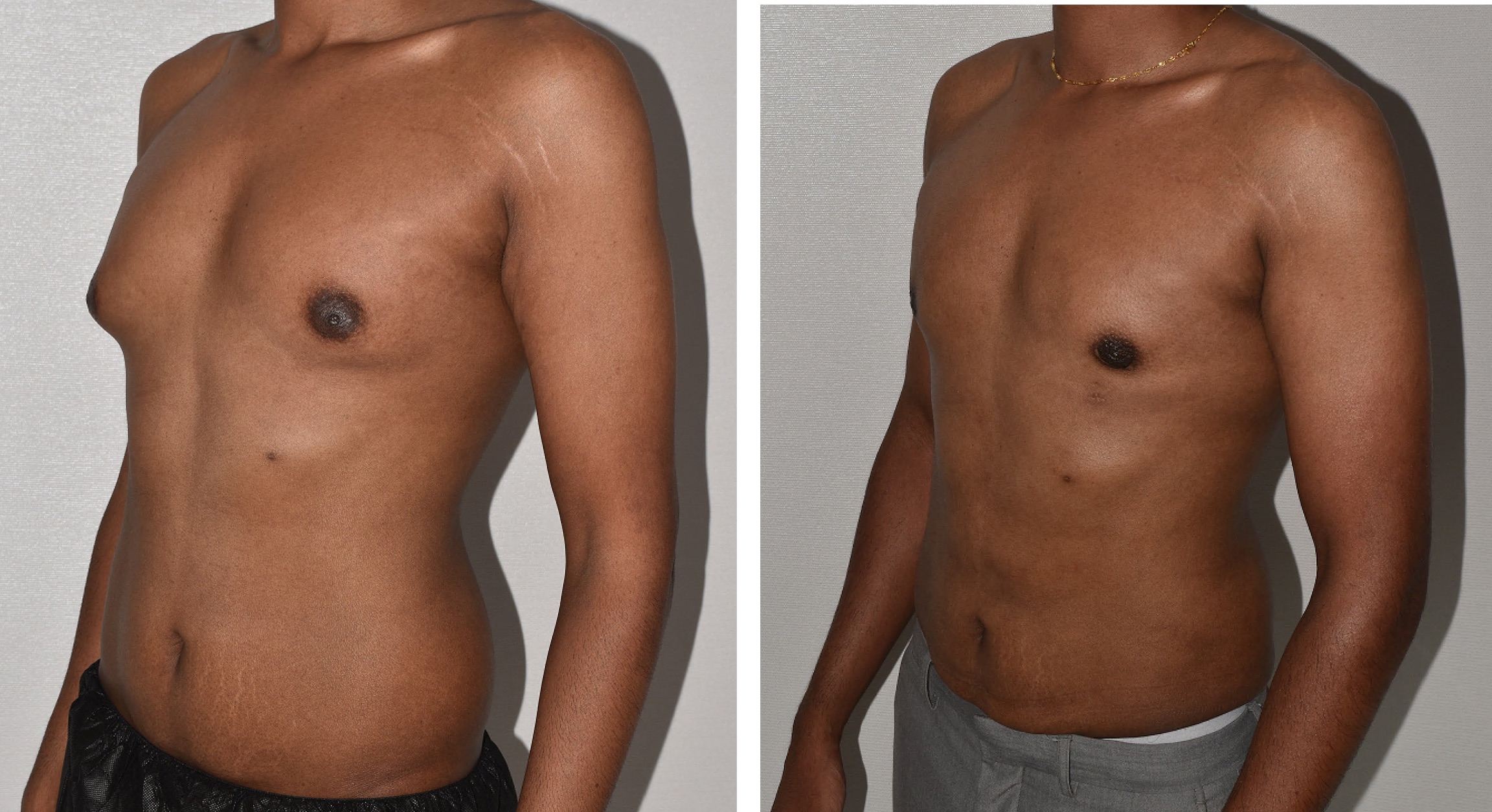 Before and after Lipo 360, case 11.