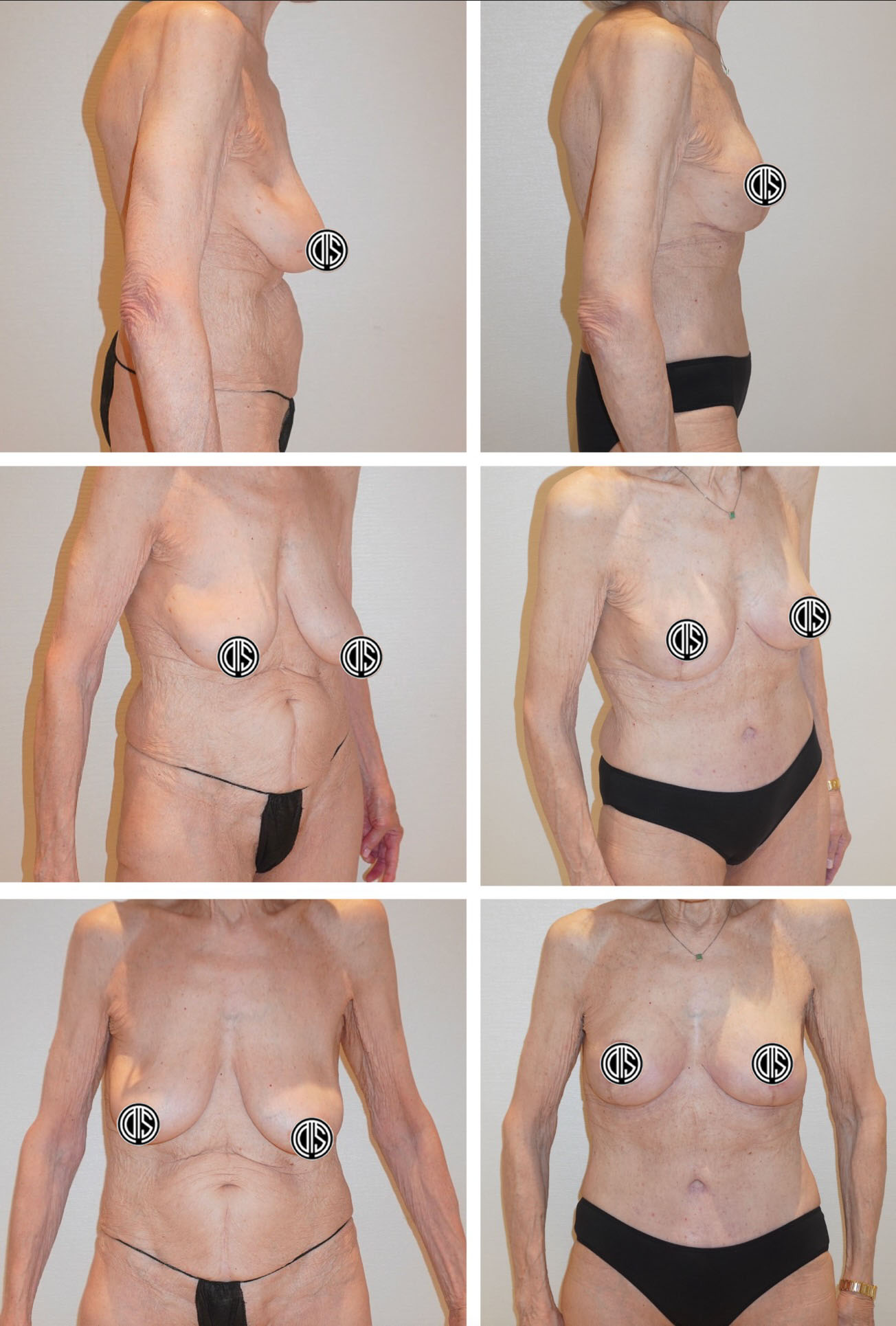 Before and after a breast lift with auto-augmentation and tummy tuck in an 80-year-old patient. Her breast reshaping used her existing tissue as part of a plan addressing breast and abdominal contours.