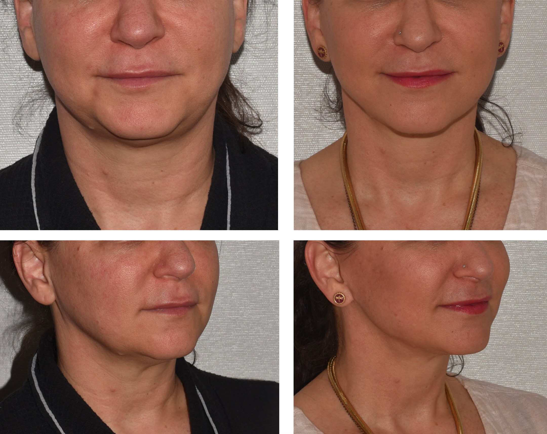 Facelift before and after photographs, photo set 1.