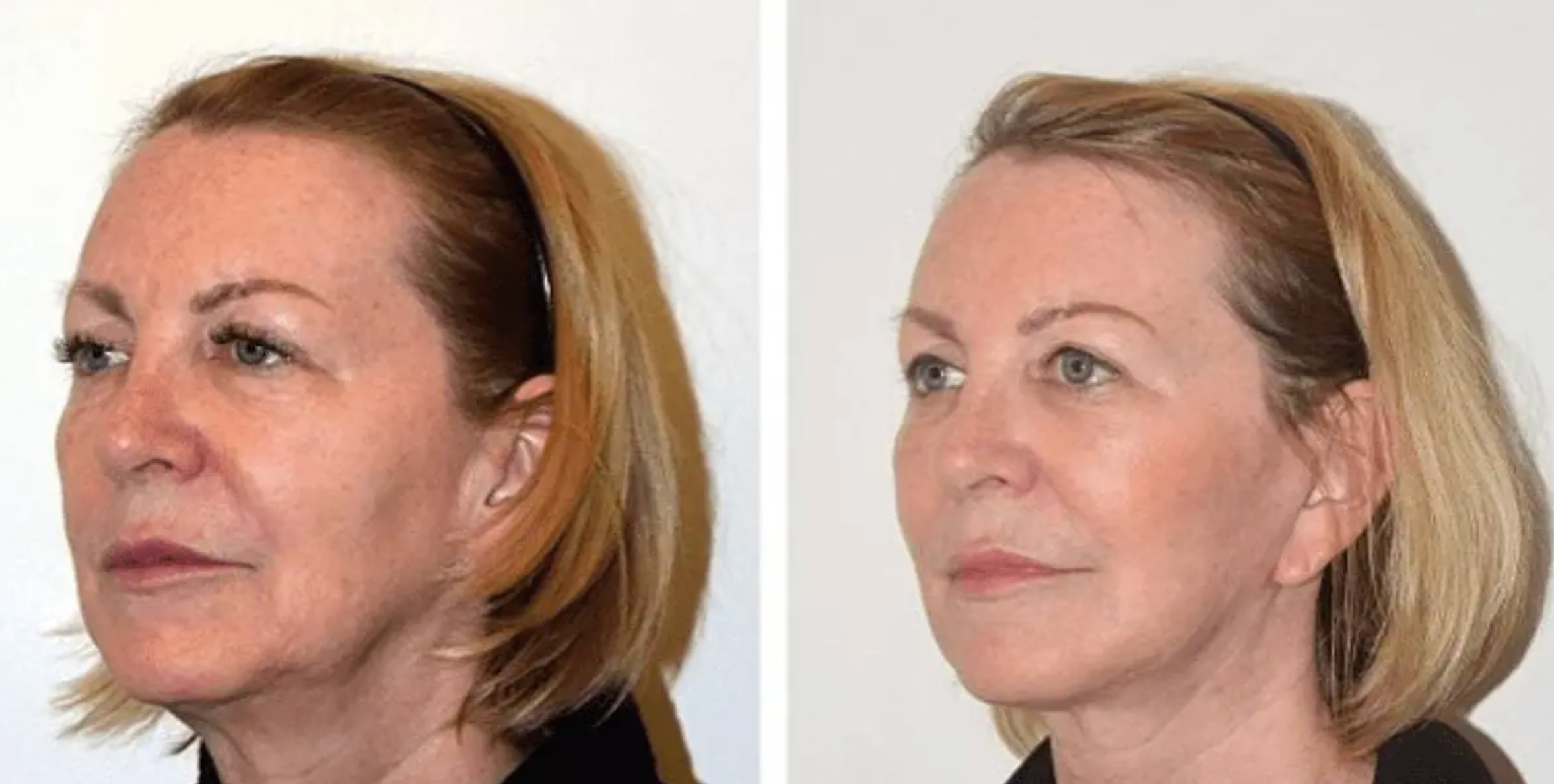 Facelift before and after photographs, photo set 3.