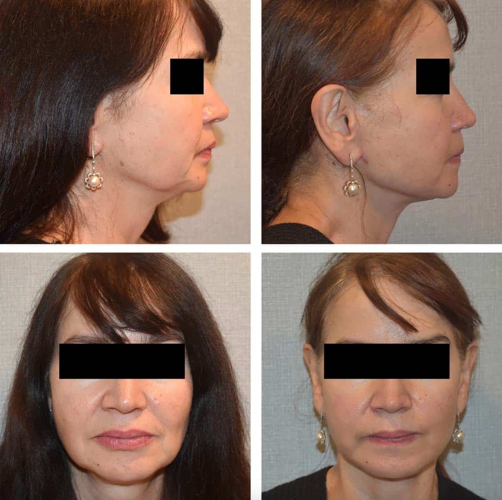 Facelift before and after photographs, photo set 2.