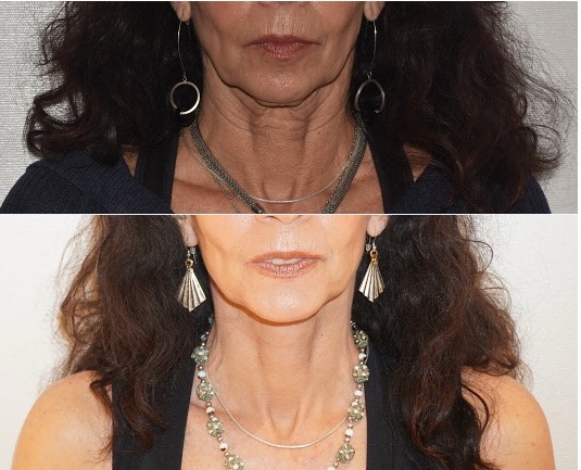 Facelift before and after photographs, photo set 7.