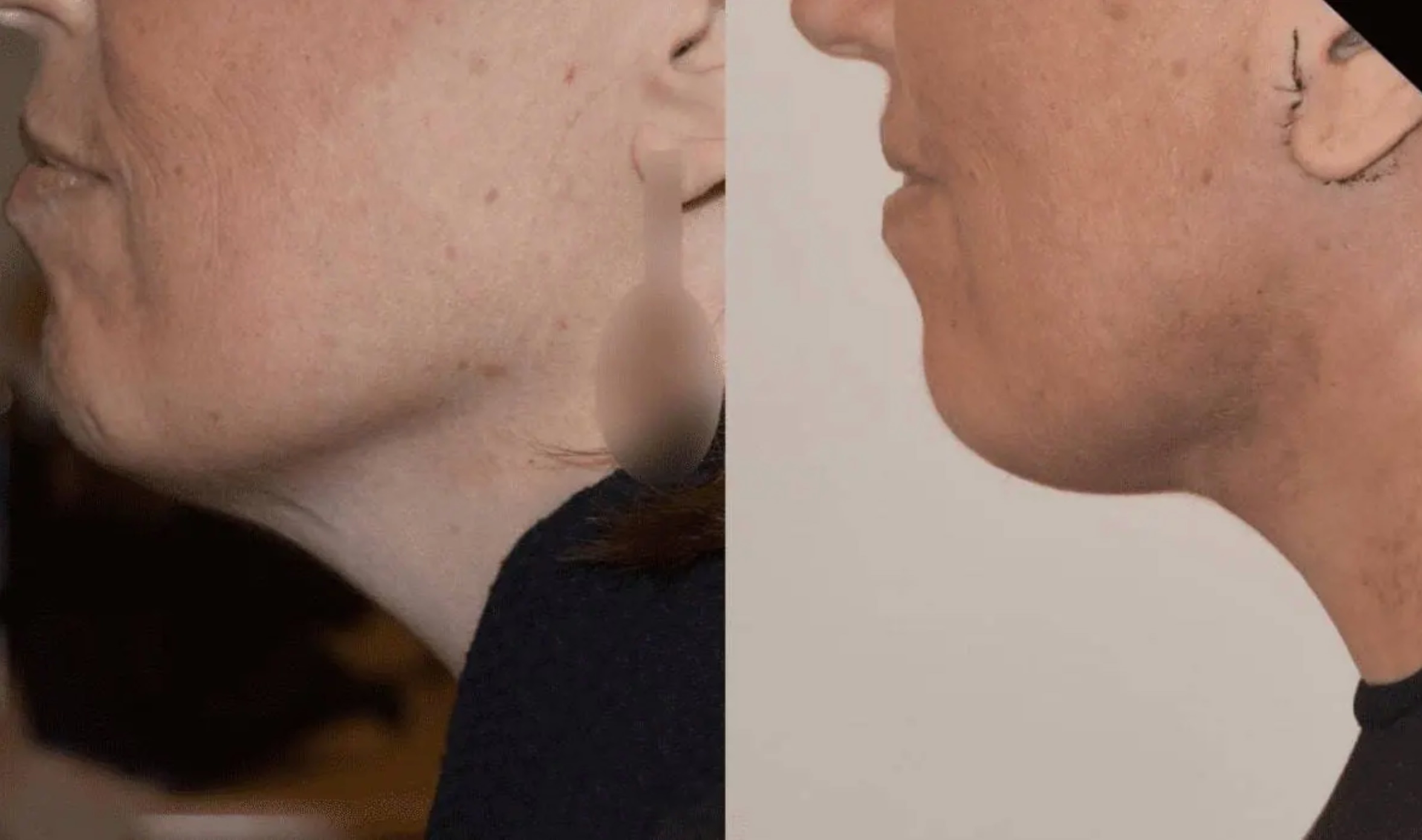 Facelift before and after photographs, photo set 9.