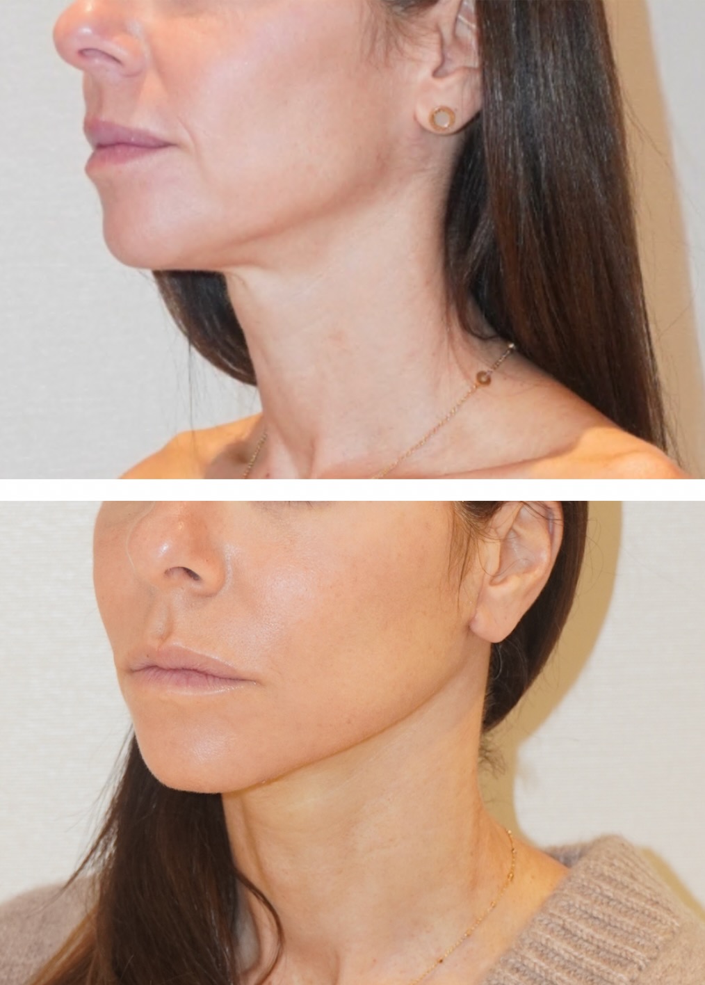 Facelift before and after photographs, photo set 11.