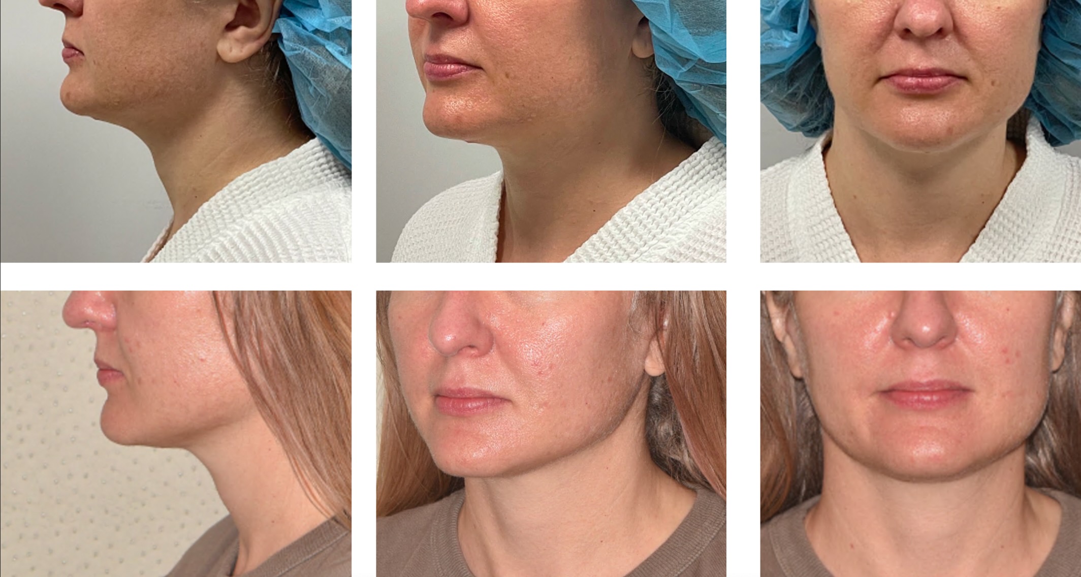 Facelift before and after photographs, photo set 8.