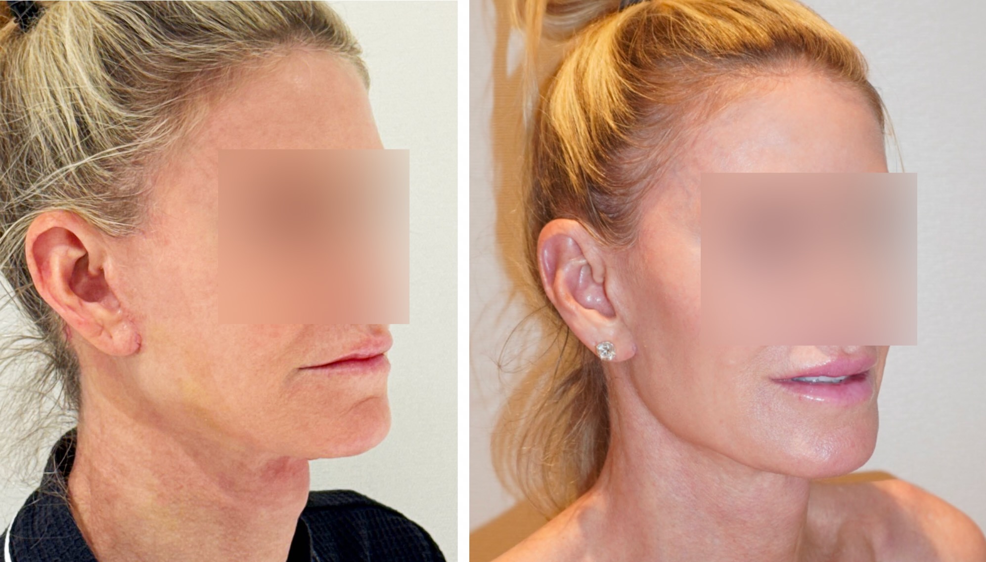 Facelift before and after photographs, photo set 10.