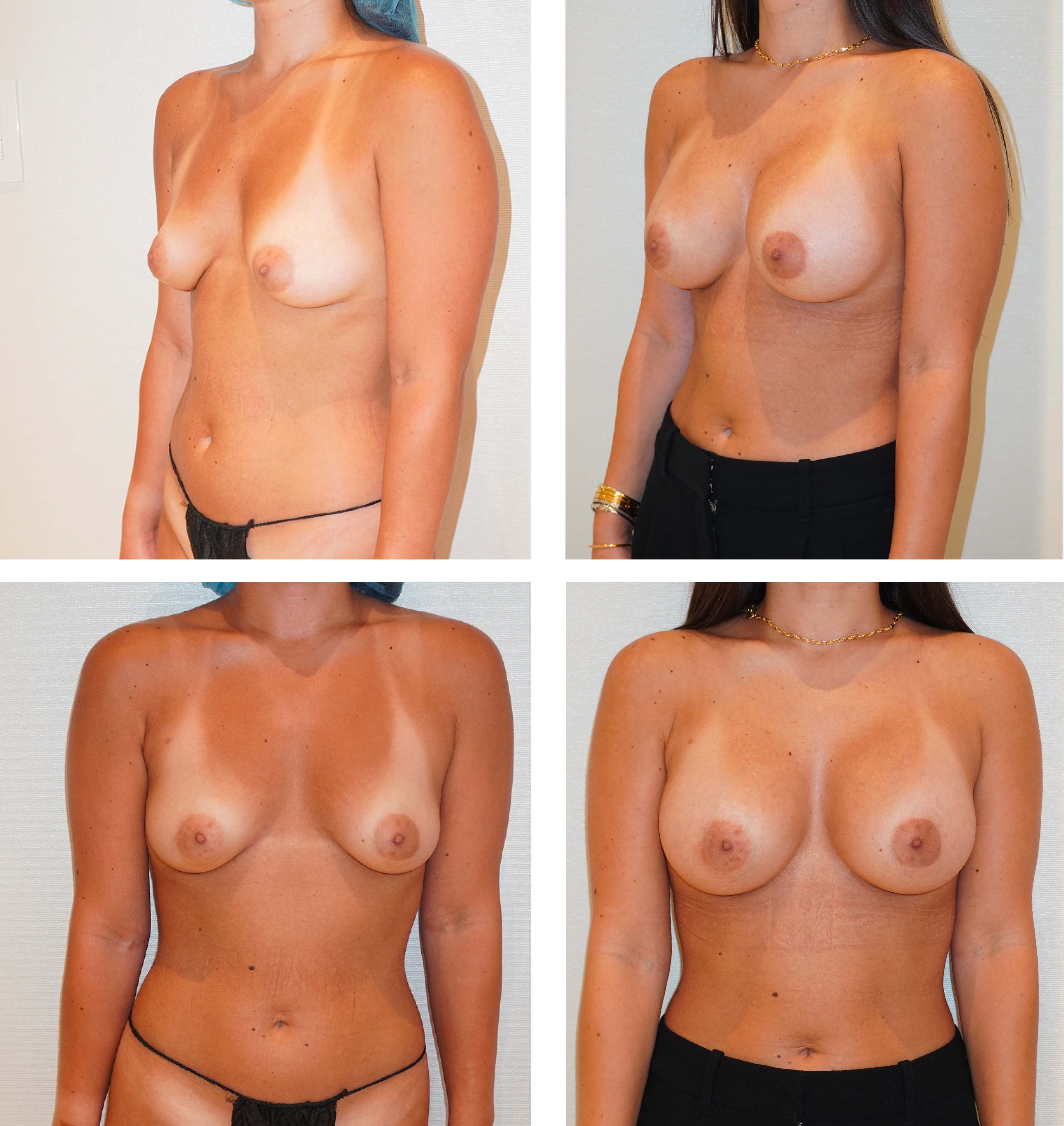 Before and after breast augmentation with 260 cc Motiva Ergonomix implants. Oblique and front views. Individual results vary.
