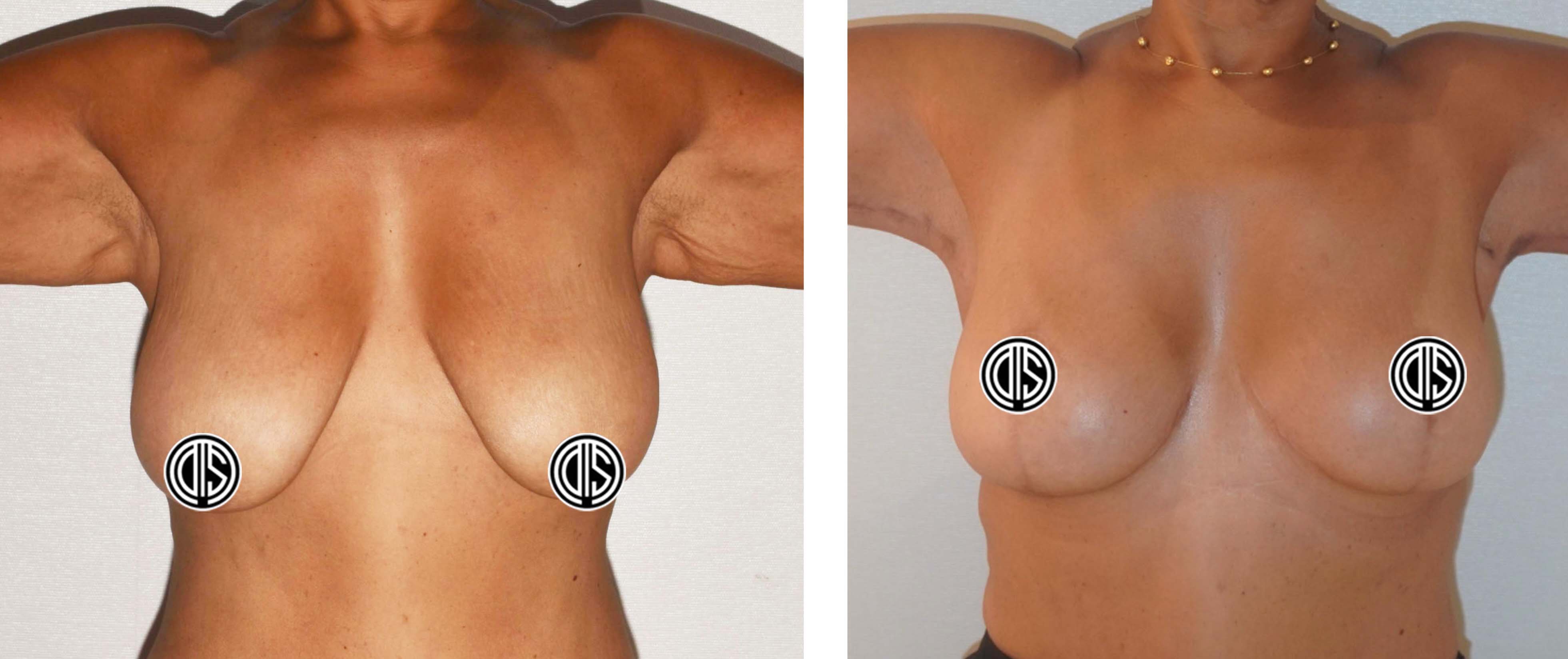 Before and after breast reduction, case 1.