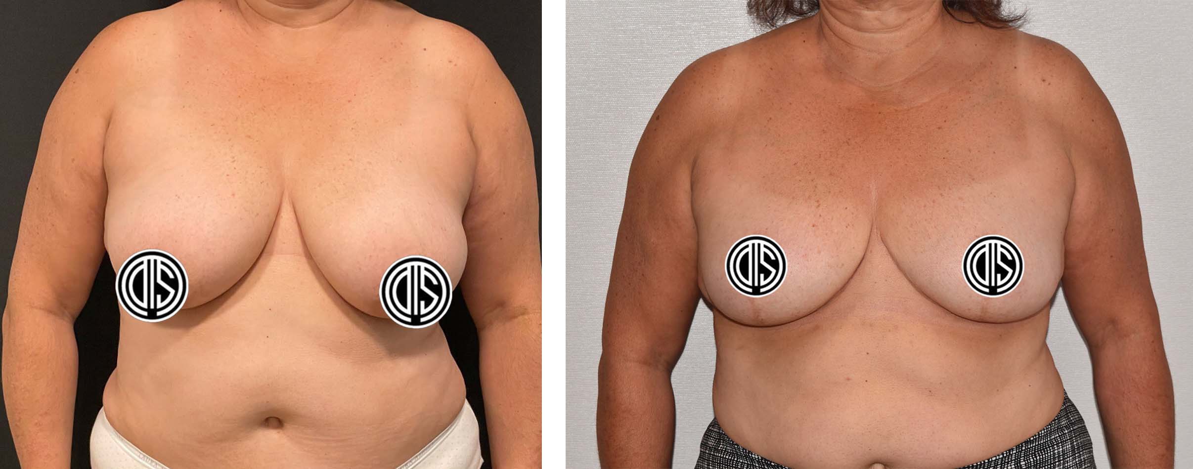 Before and after breast reduction, case 2.