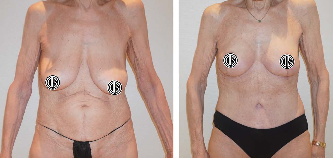 Before and after breast reduction, case 4.