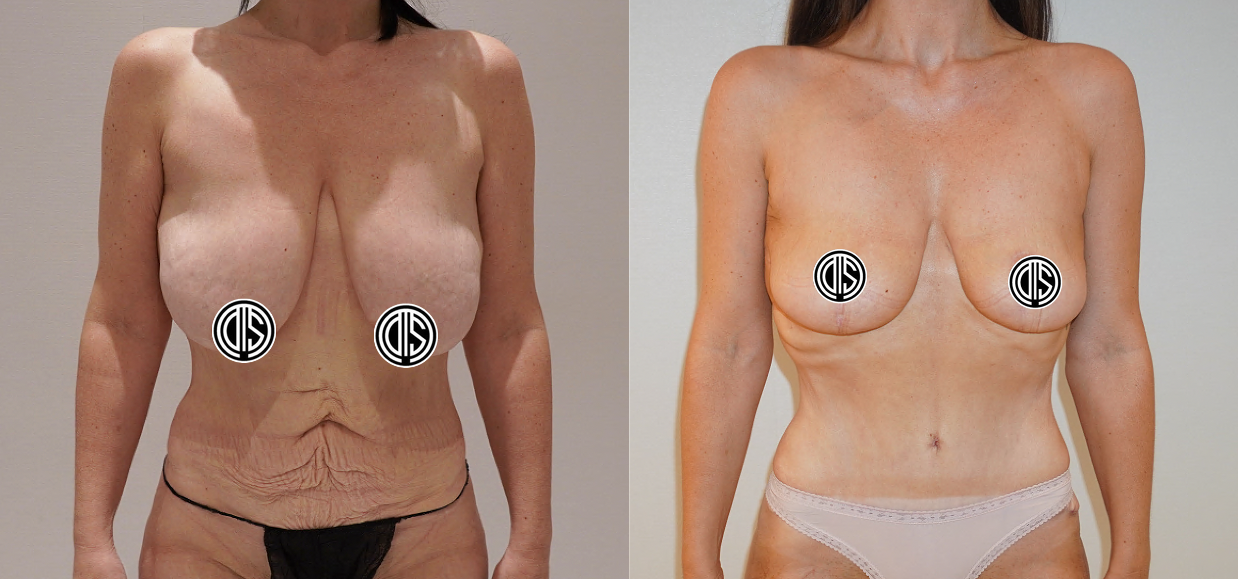 Breast Reduction Case 3: before and after breast reduction and lift with auto-augmentation.