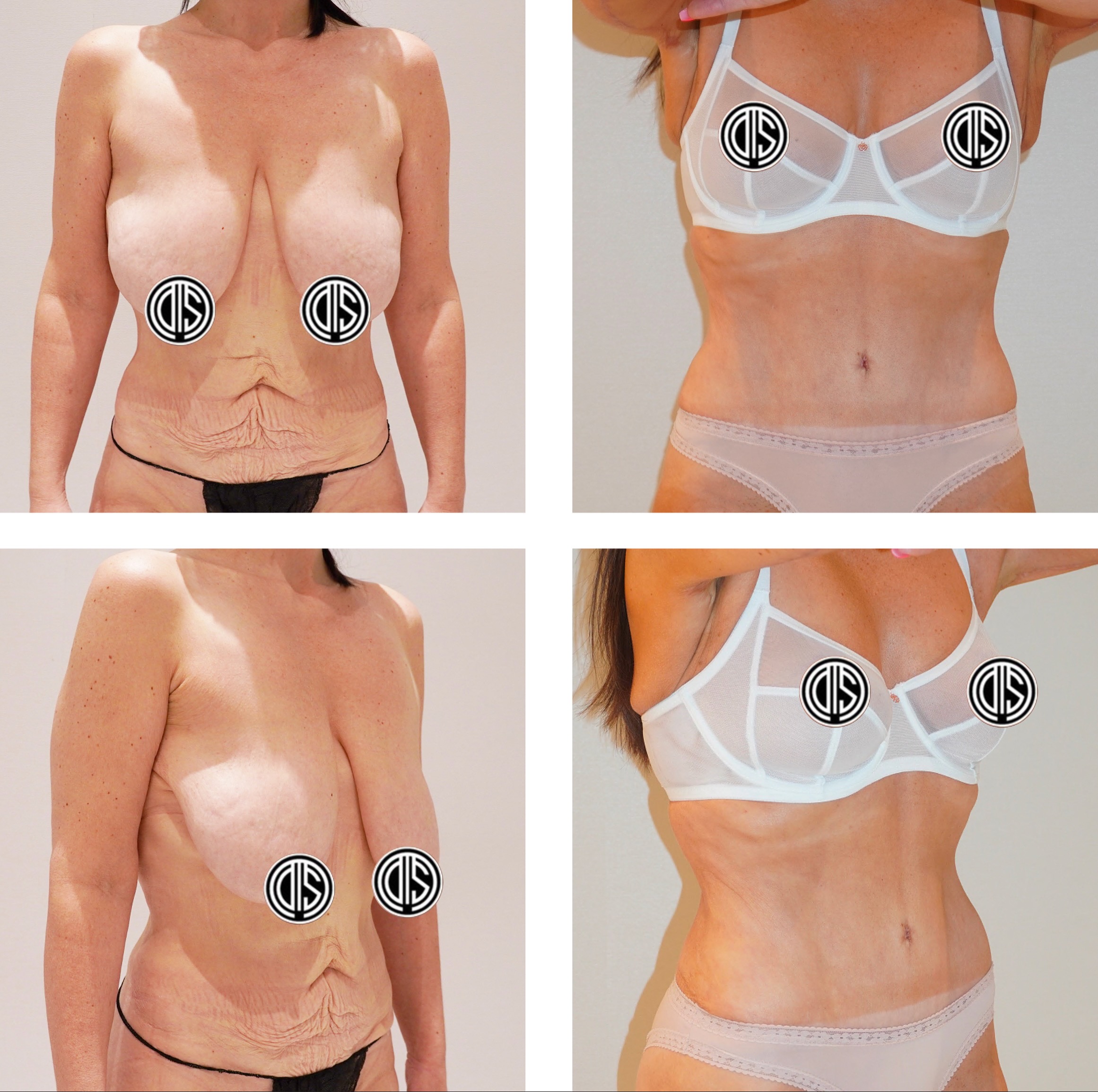Case 2a · Abdomen: before and after skin-only tummy tuck (abdominoplasty). Individual results vary.