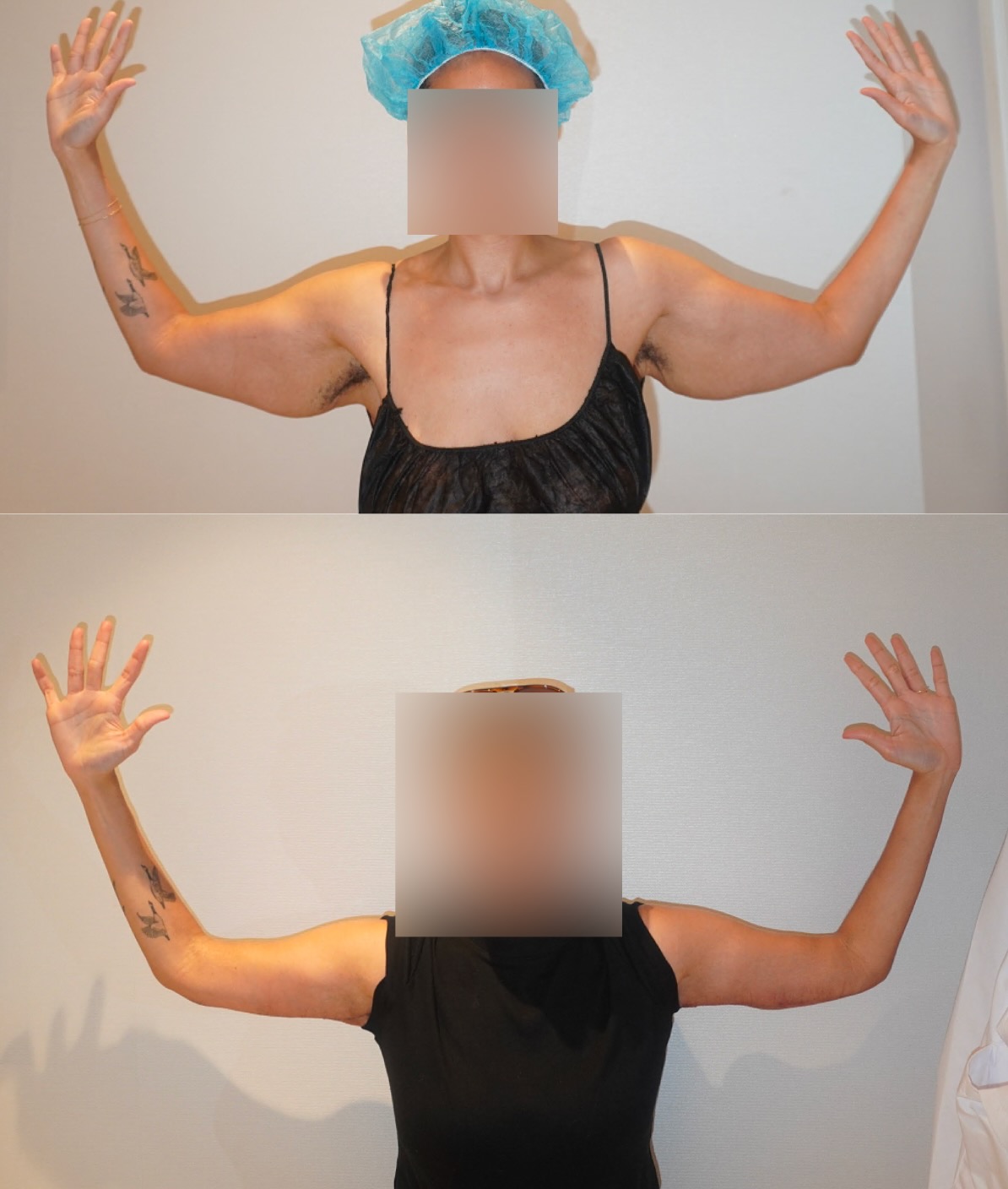 Before and 6 months after full brachioplasty (arm lift) following significant weight loss with Mounjaro. Individual results vary.