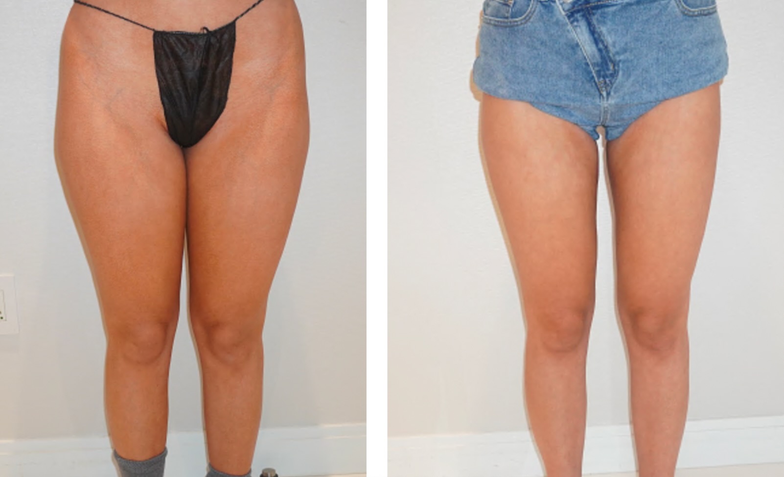 Leg liposuction photographs, Photo 109.