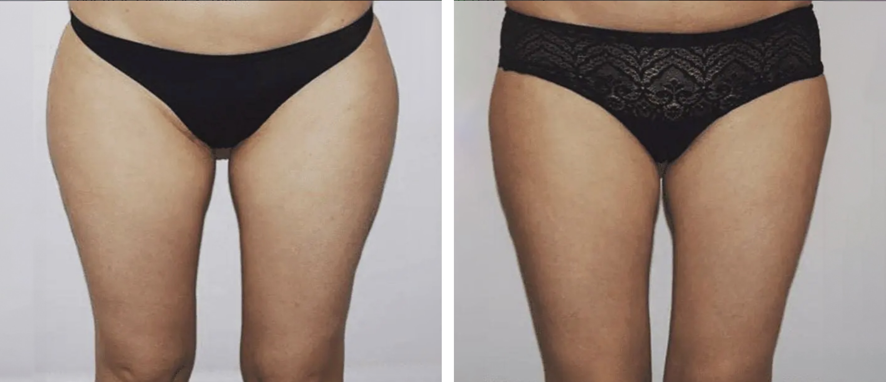 Leg liposuction photographs, Photo 116.