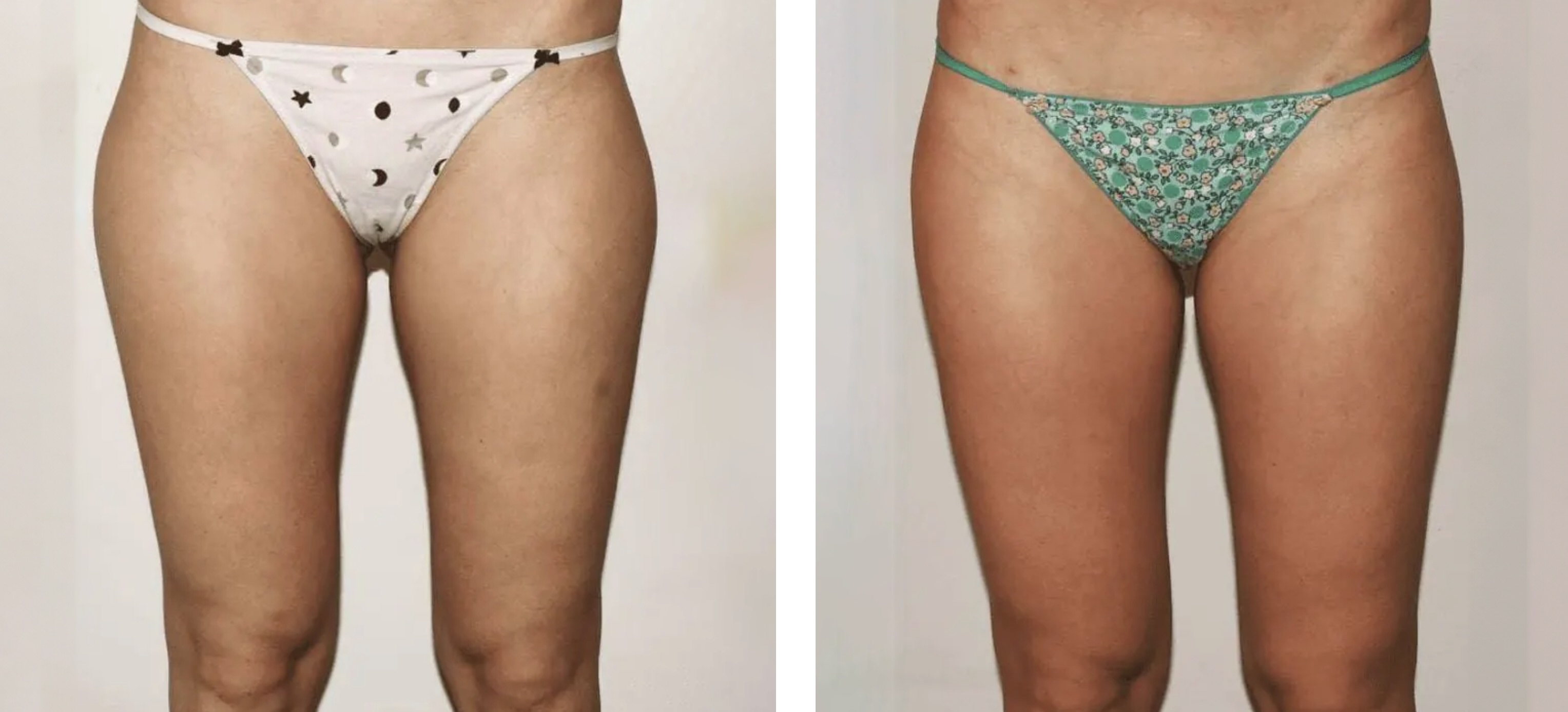 Leg liposuction photographs, Photo 117.