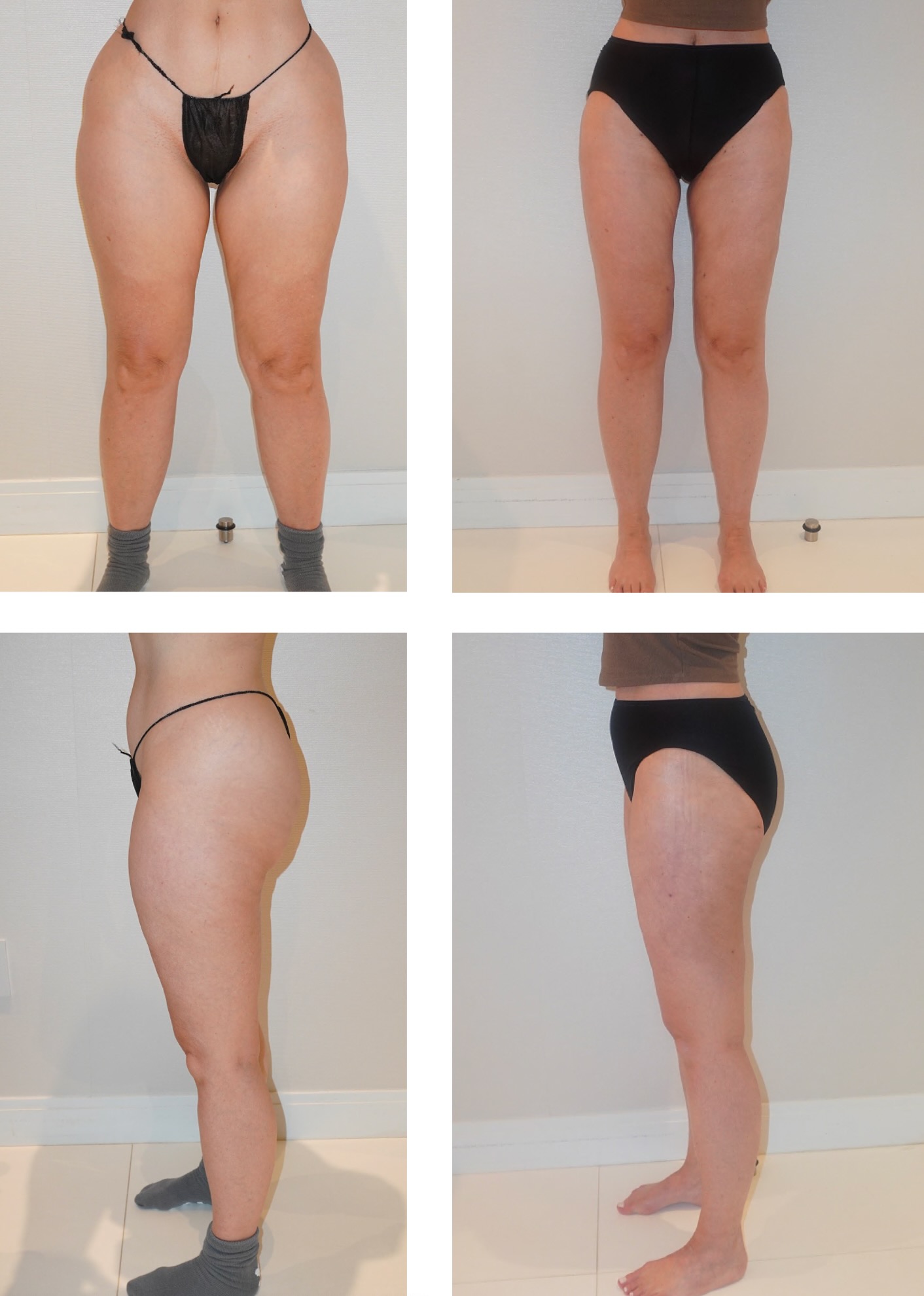 Leg liposuction photographs, Photo 92.