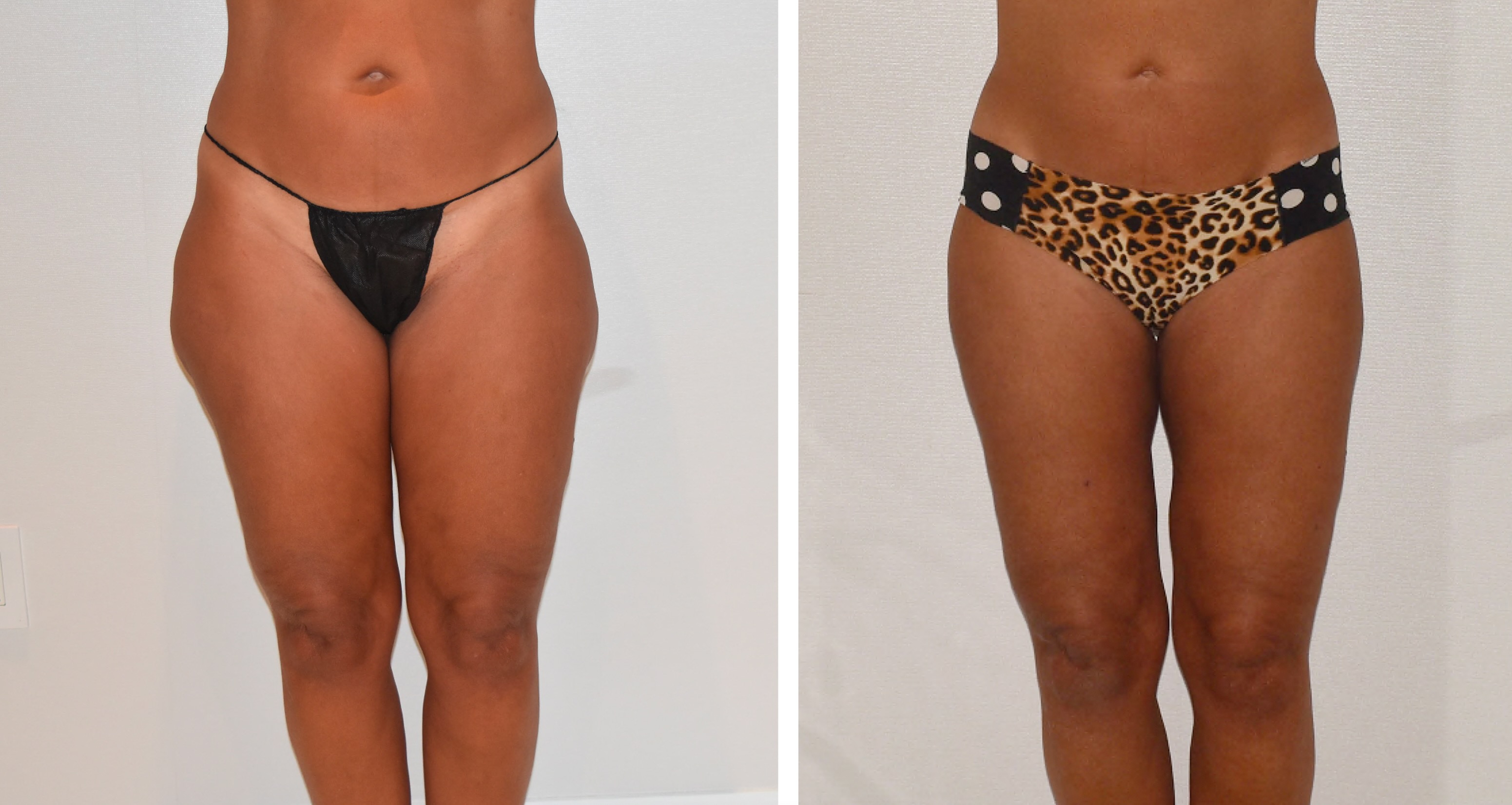 Leg liposuction photographs, Photo 102.