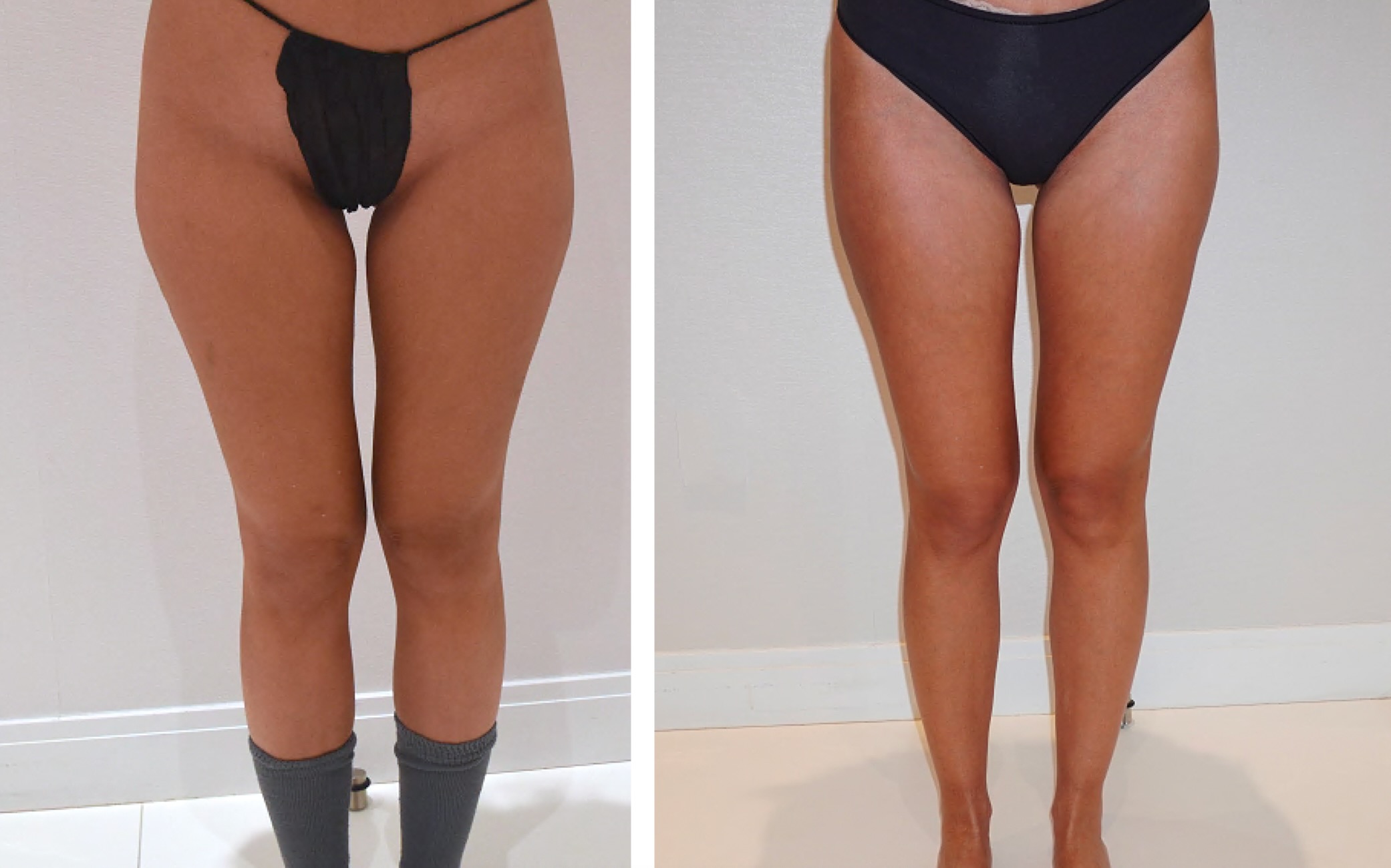 Leg liposuction photographs, Photo 138.