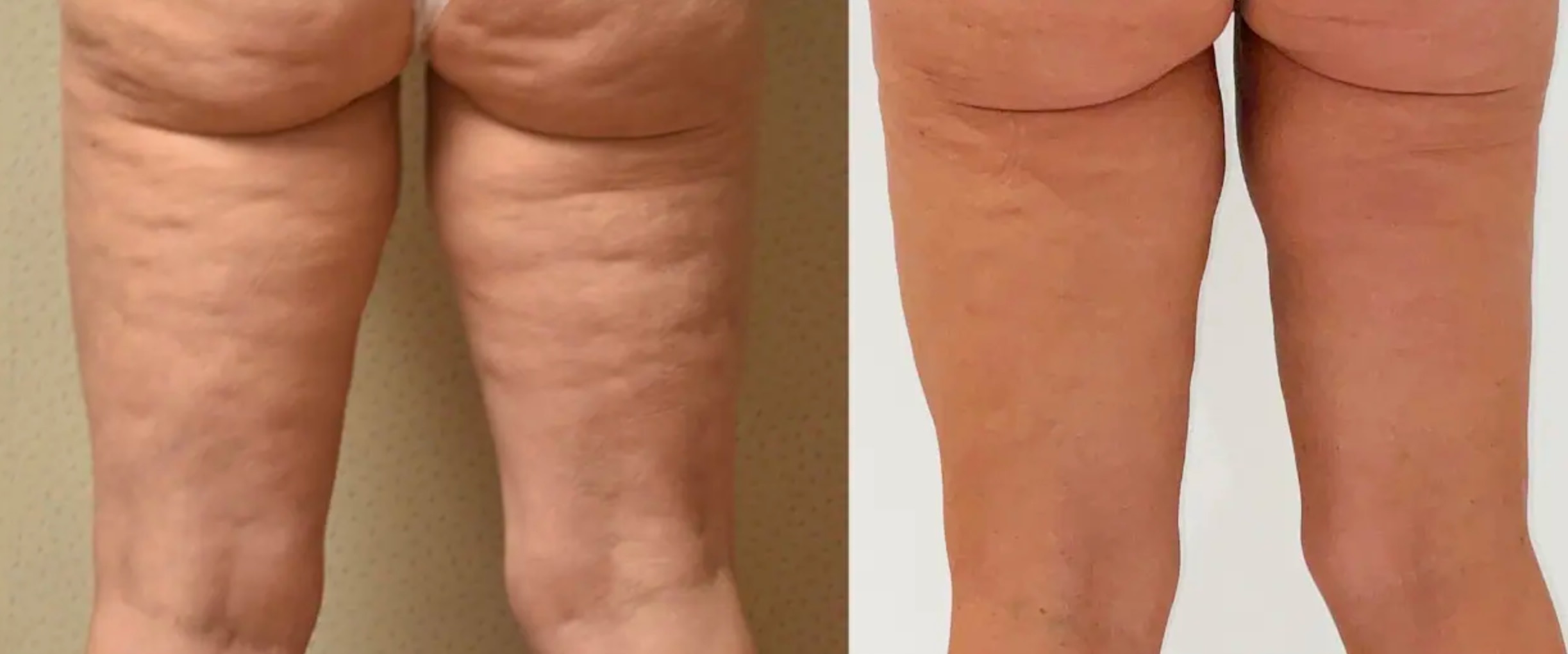 Leg liposuction photographs, Photo 142.
