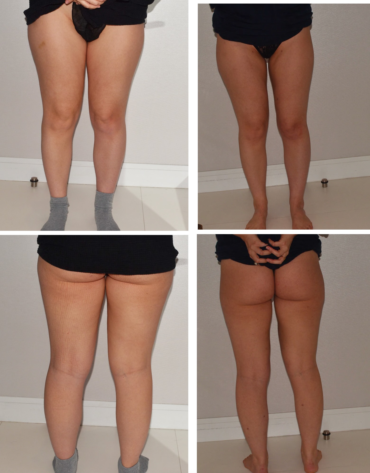 Leg liposuction photographs, Photo 143.