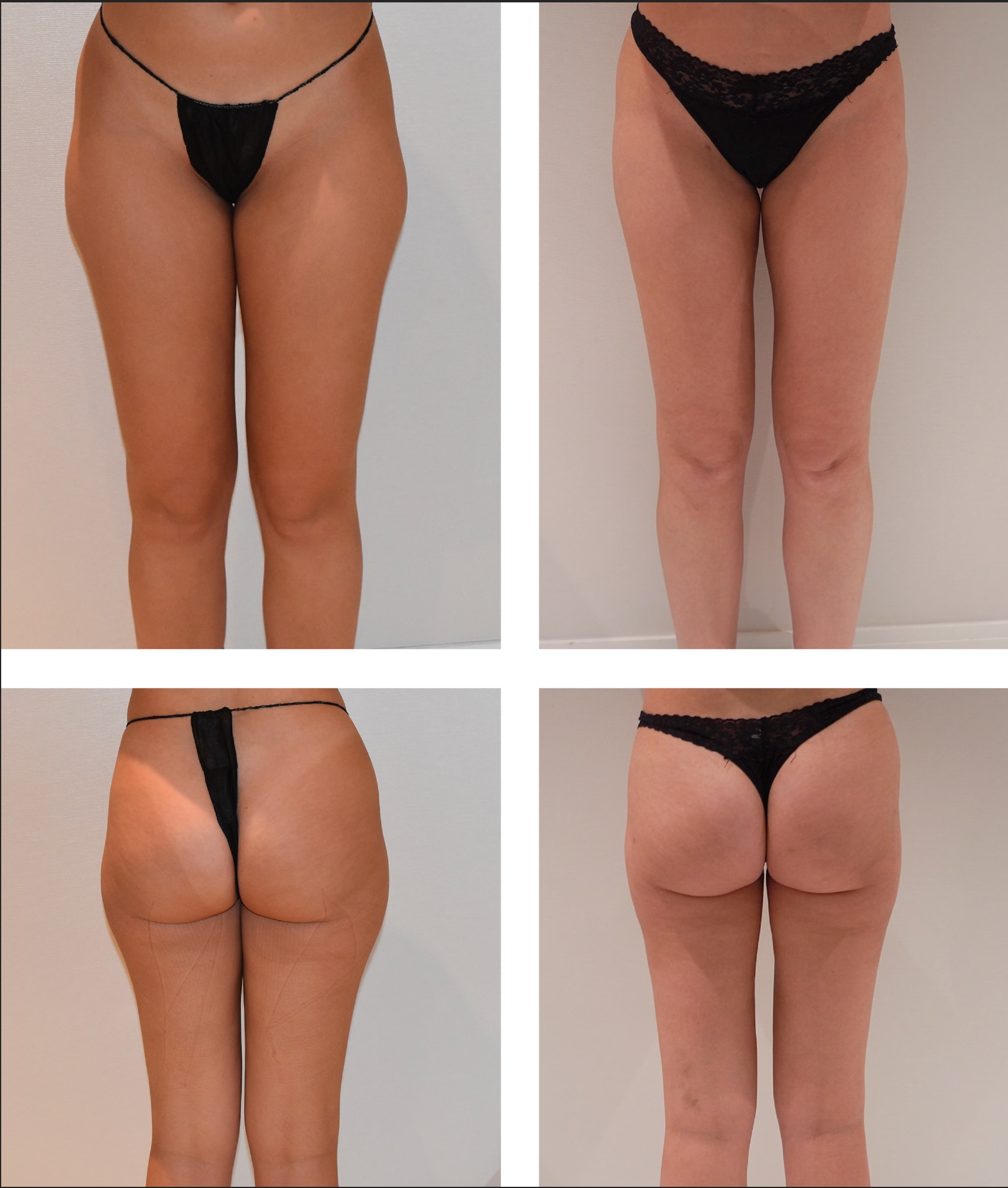 Leg liposuction photographs, Photo 149.