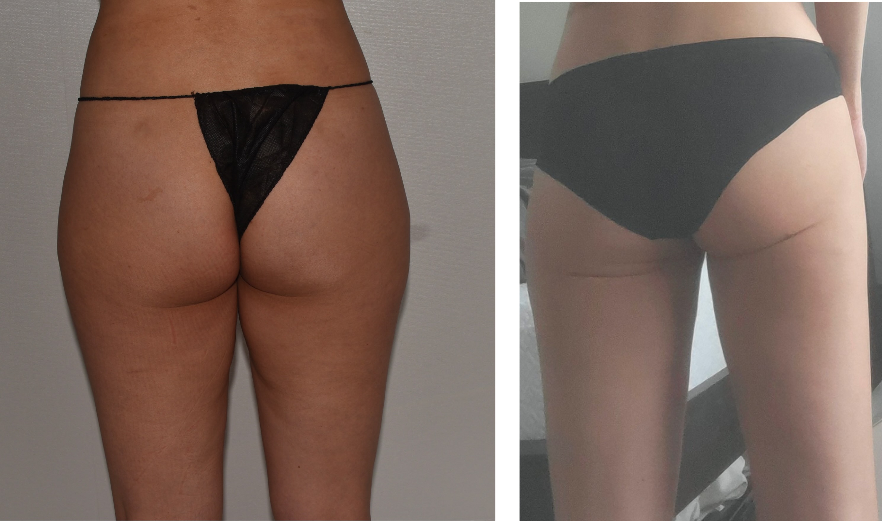 Leg liposuction photographs, Photo 139.