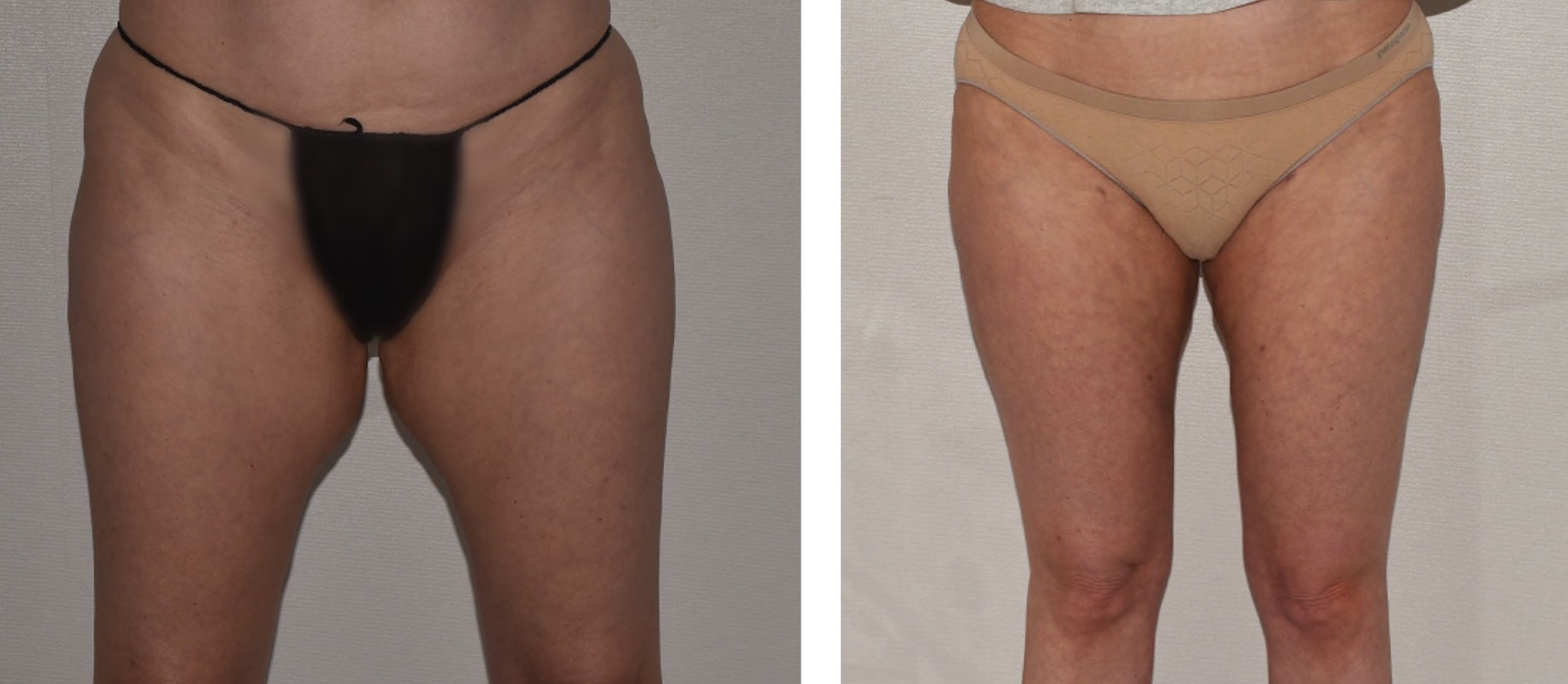 Leg liposuction photographs, Photo 157.