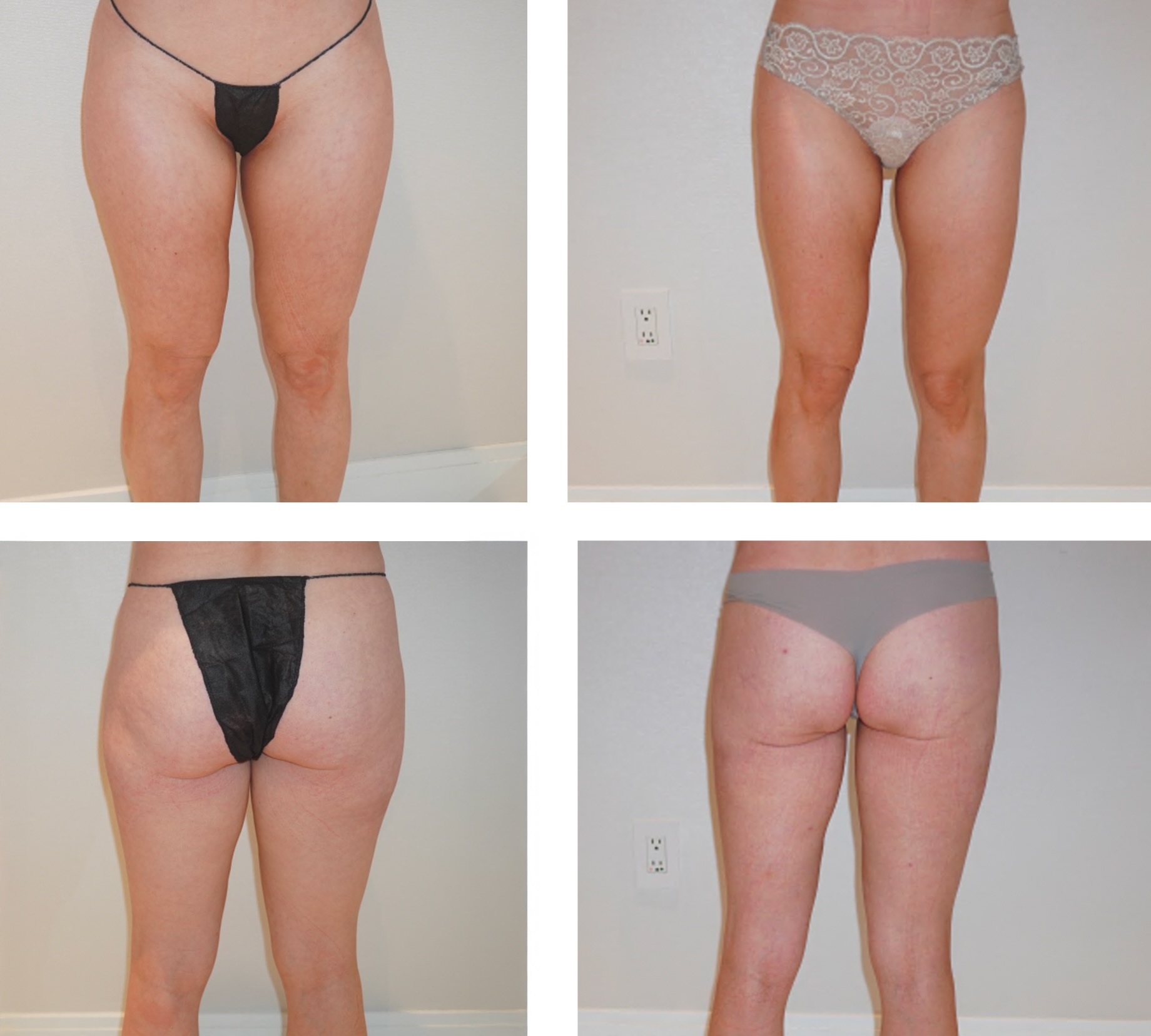 Leg liposuction photographs, Photo 202.