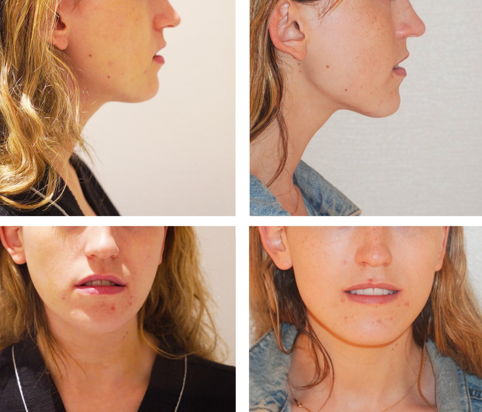Chin liposuction photographs, Photo 99.