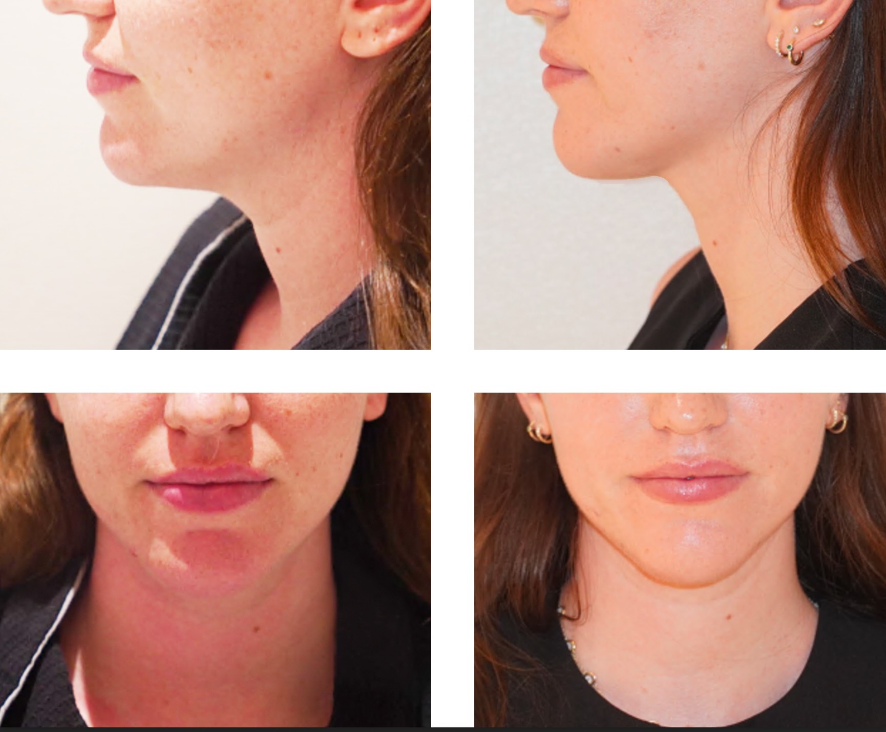Chin liposuction photographs, Photo 97.