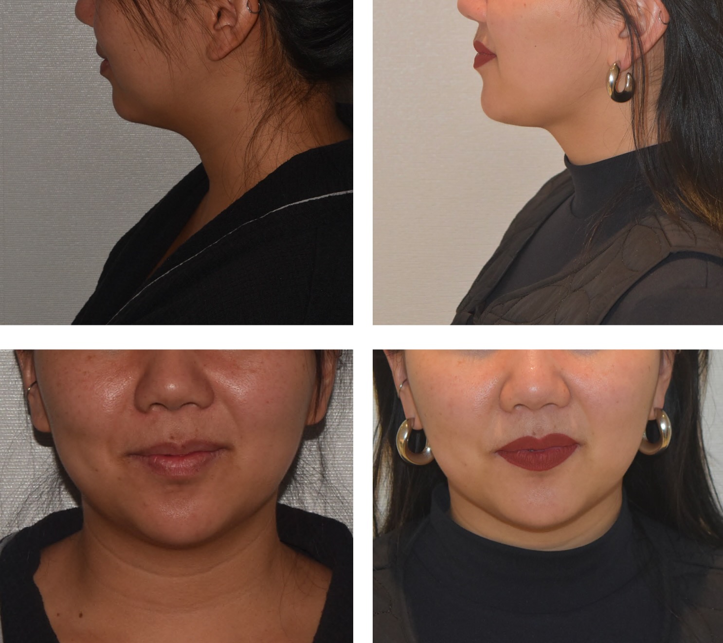 Chin liposuction photographs, Photo 161.