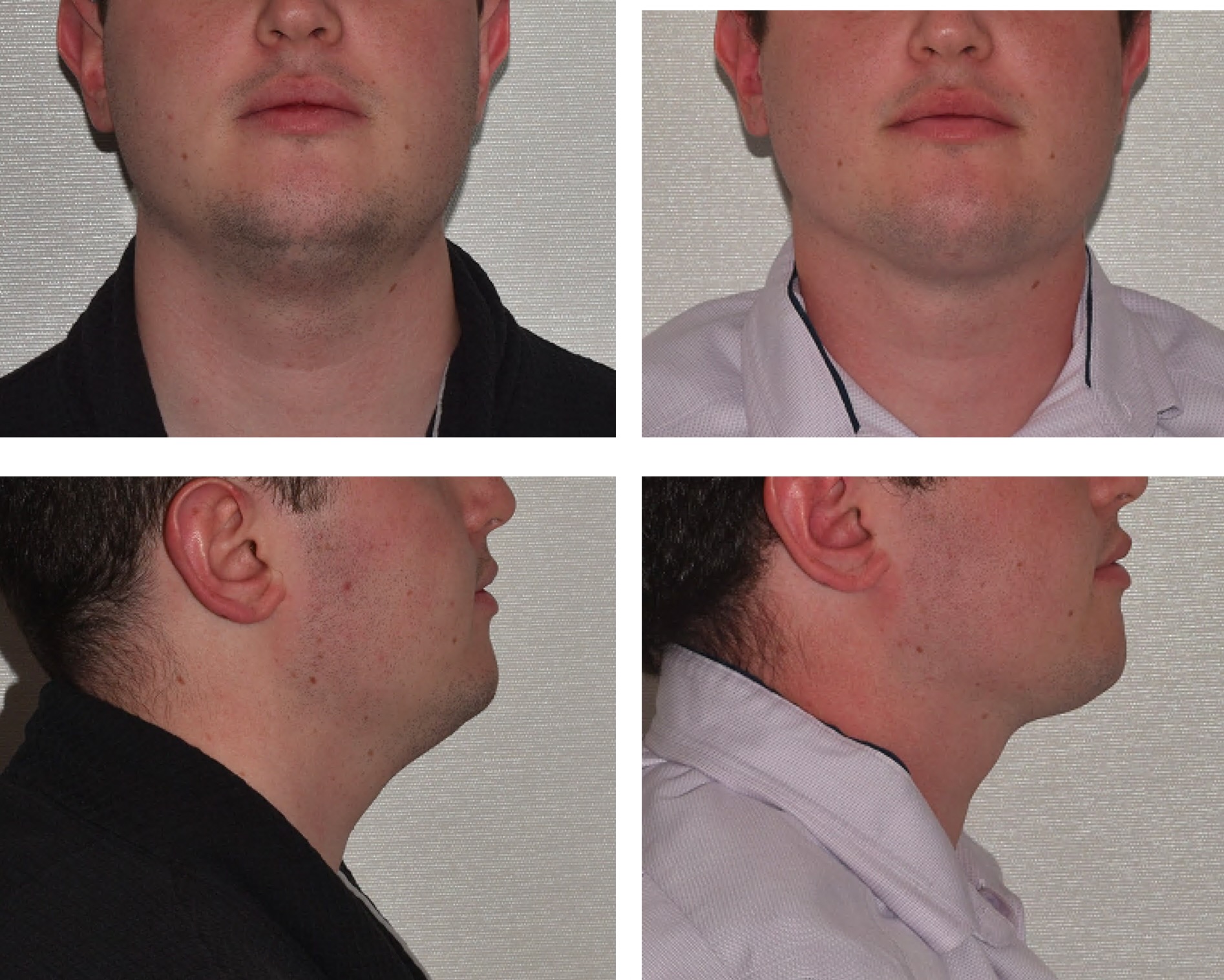 Chin liposuction photographs, Photo 14.