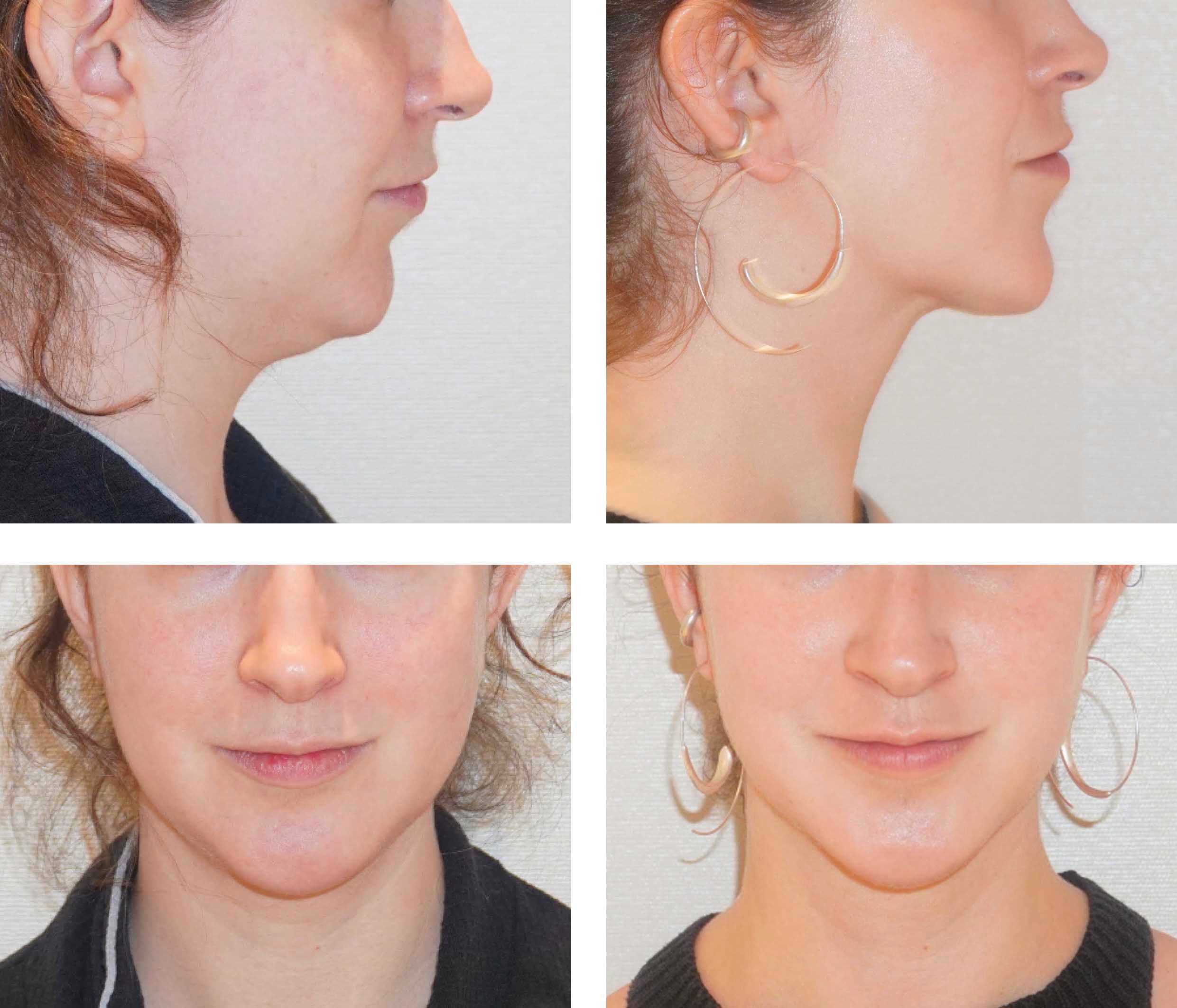 Chin liposuction photographs, b40.