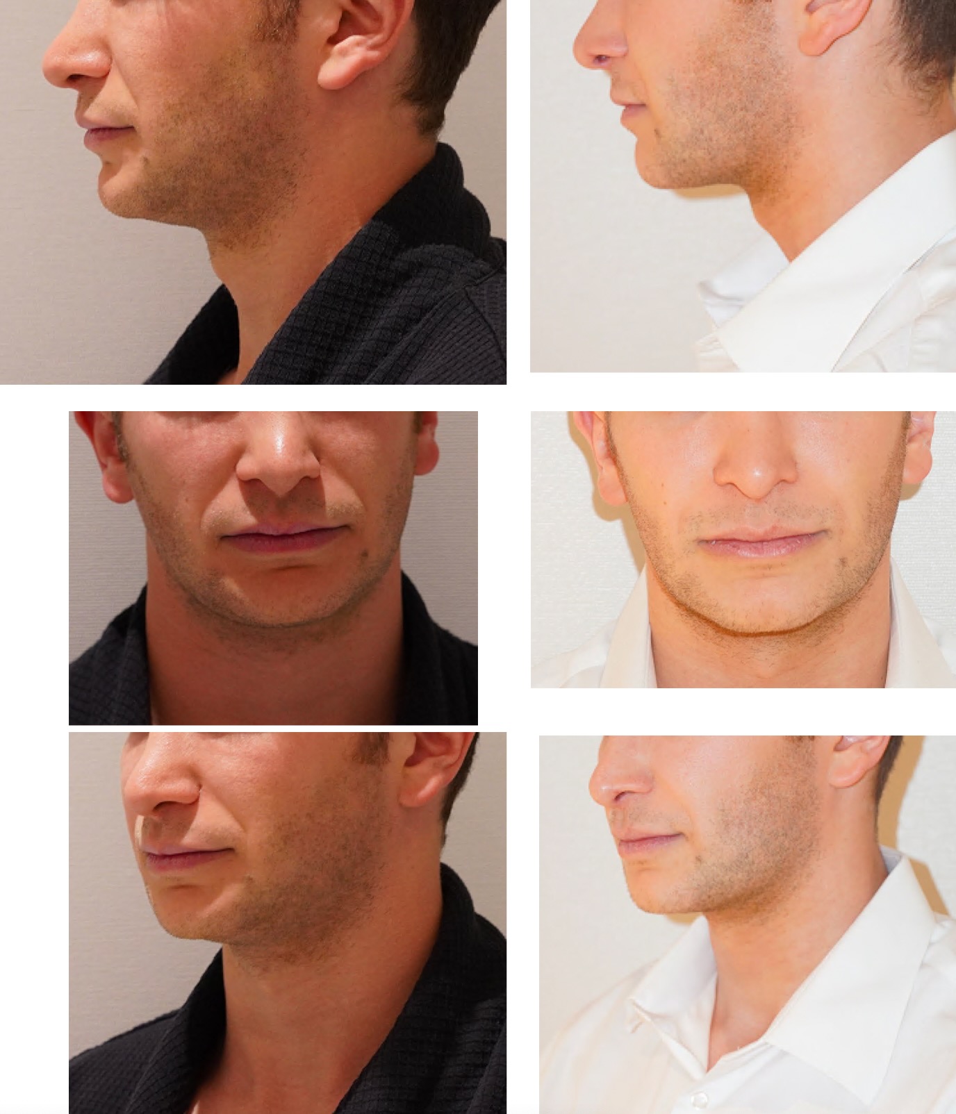 Chin liposuction photographs, Photo 126.